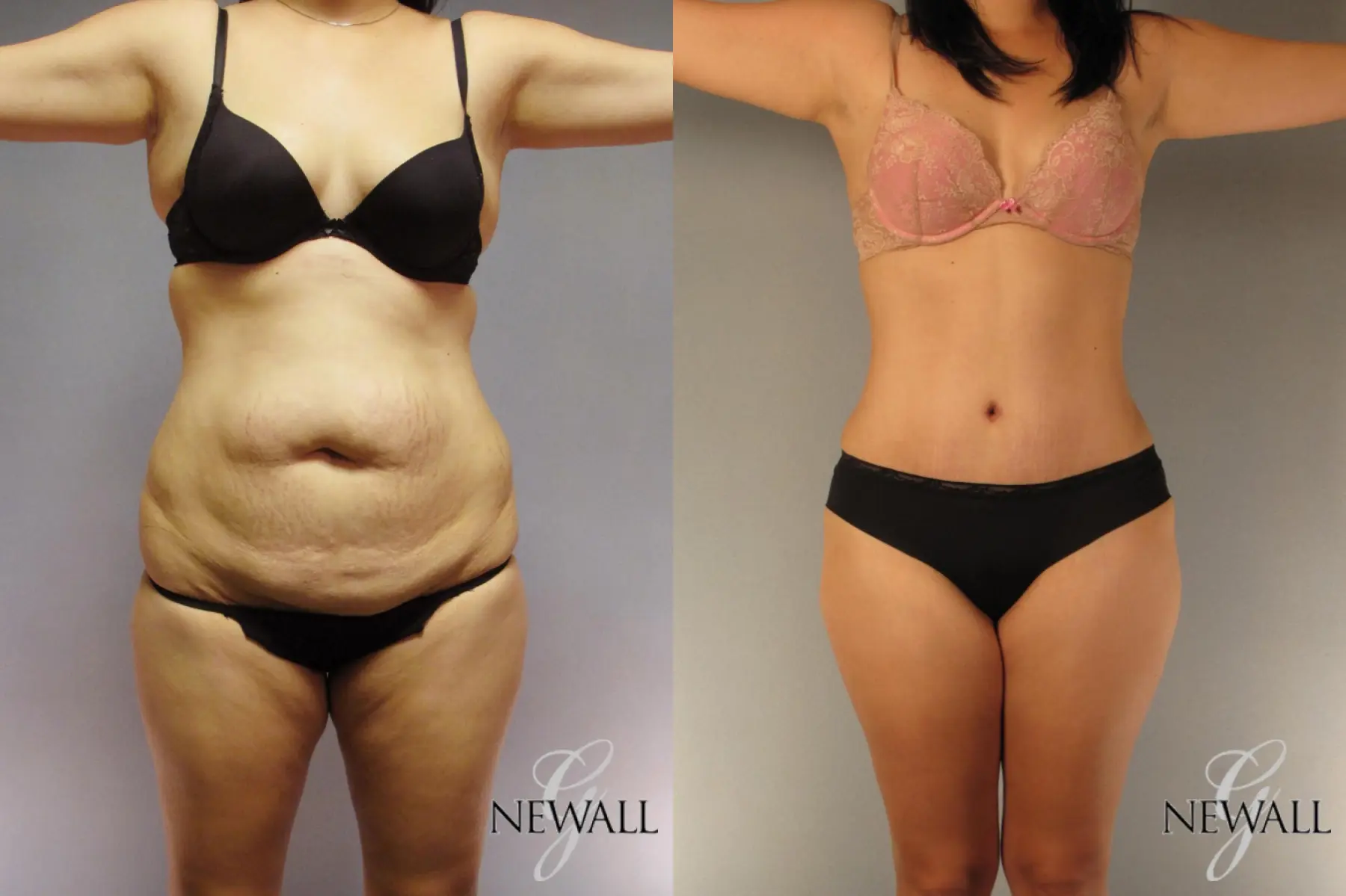 Tummy Tuck: Patient 7 - Before and After  