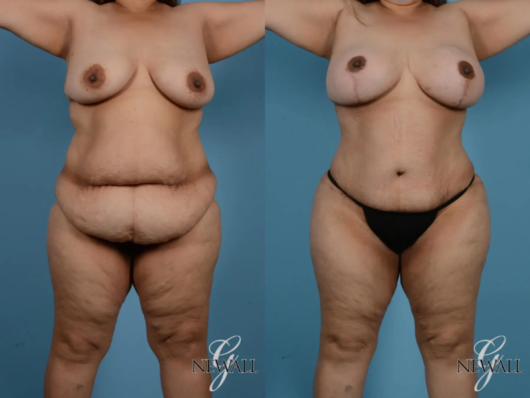 Tummy Tuck: Patient 19 - Before and After  