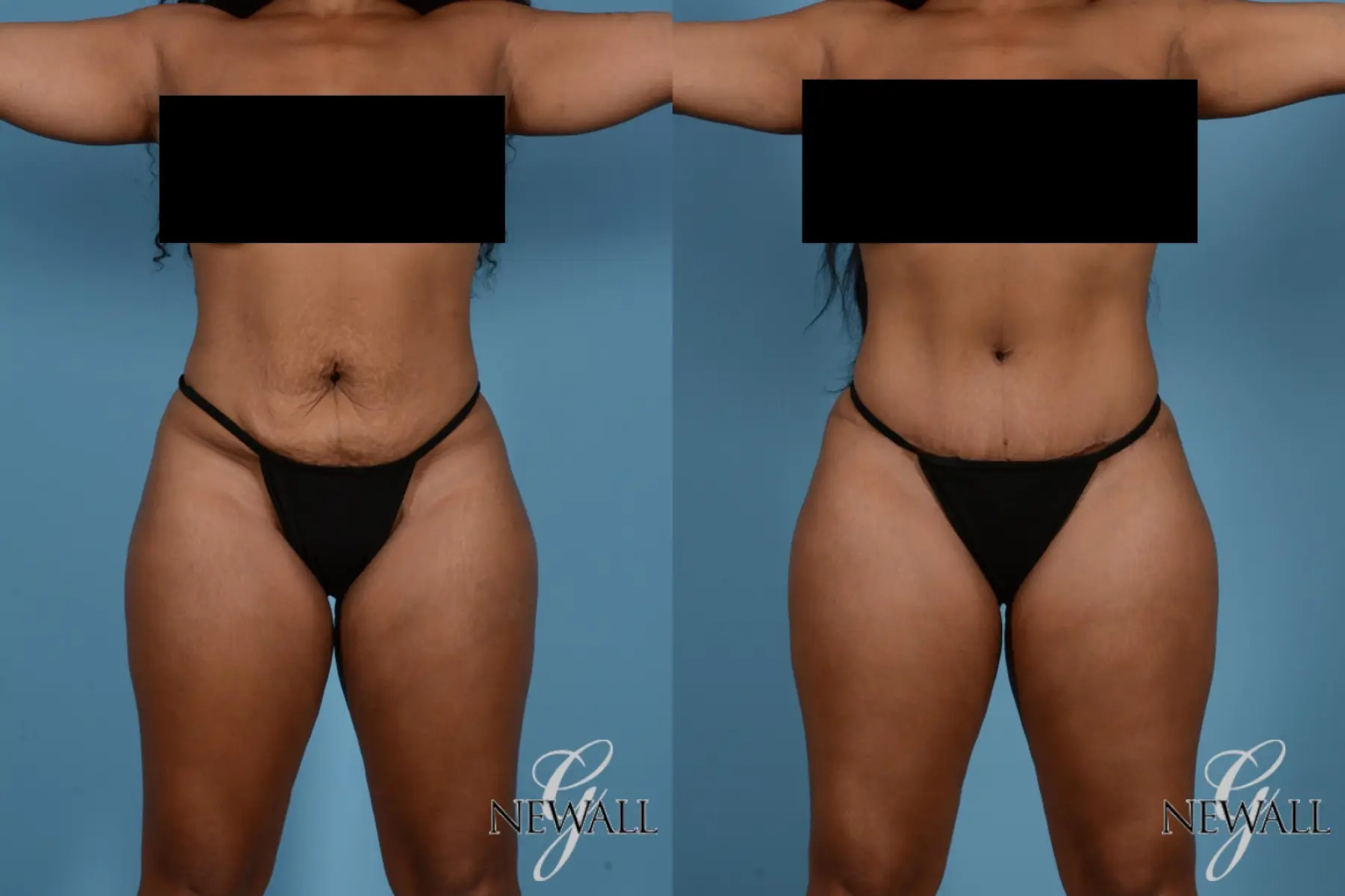 Tummy Tuck: Patient 15 - Before and After  