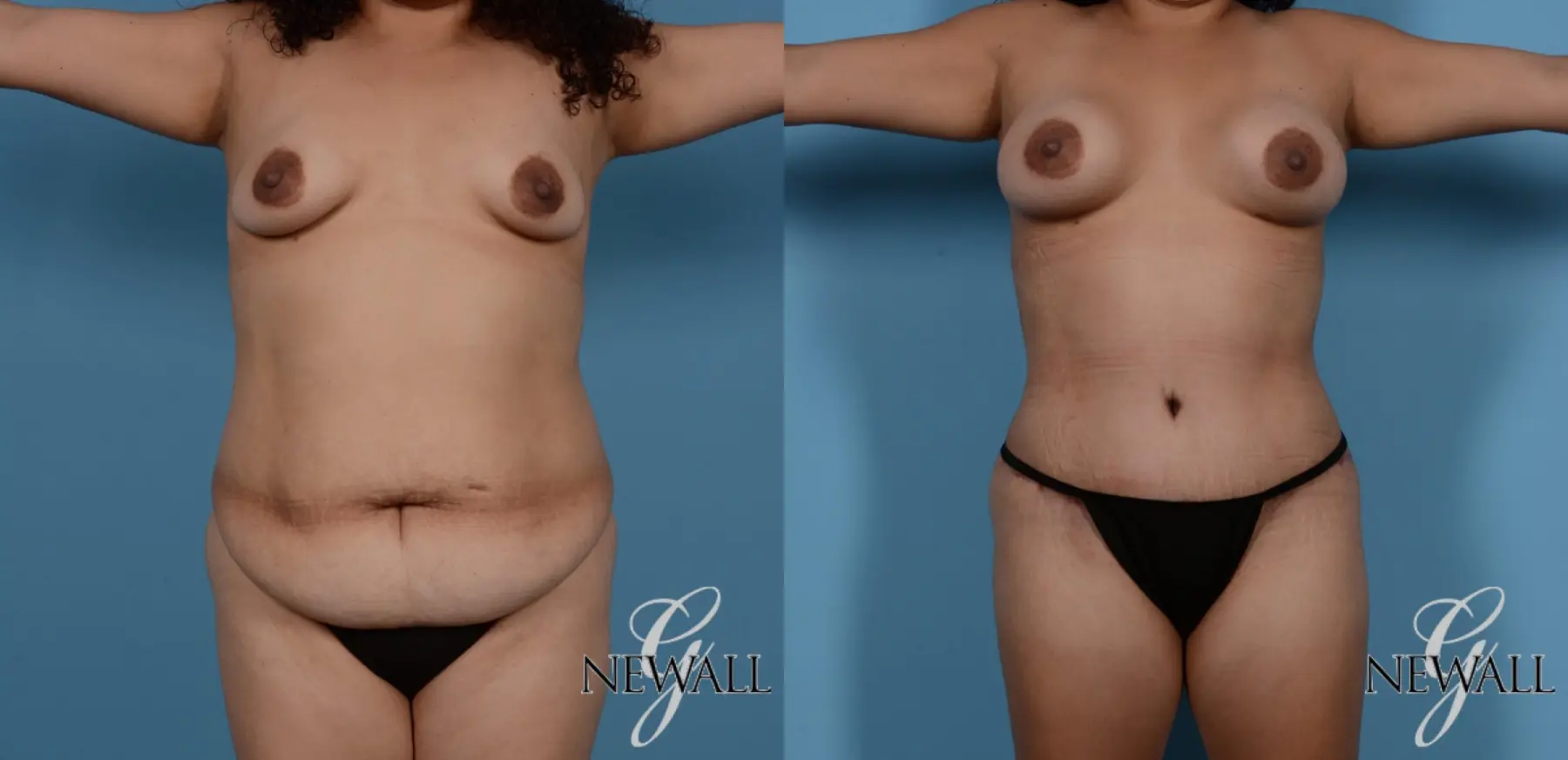 Tummy Tuck: Patient 3 - Before and After  