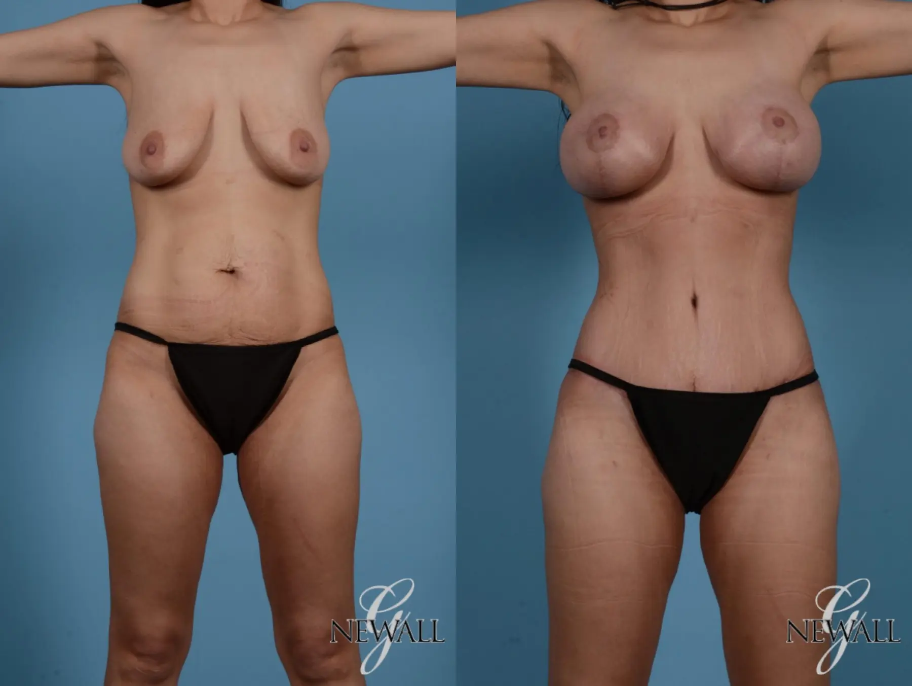 Tummy Tuck: Patient 1 - Before and After  