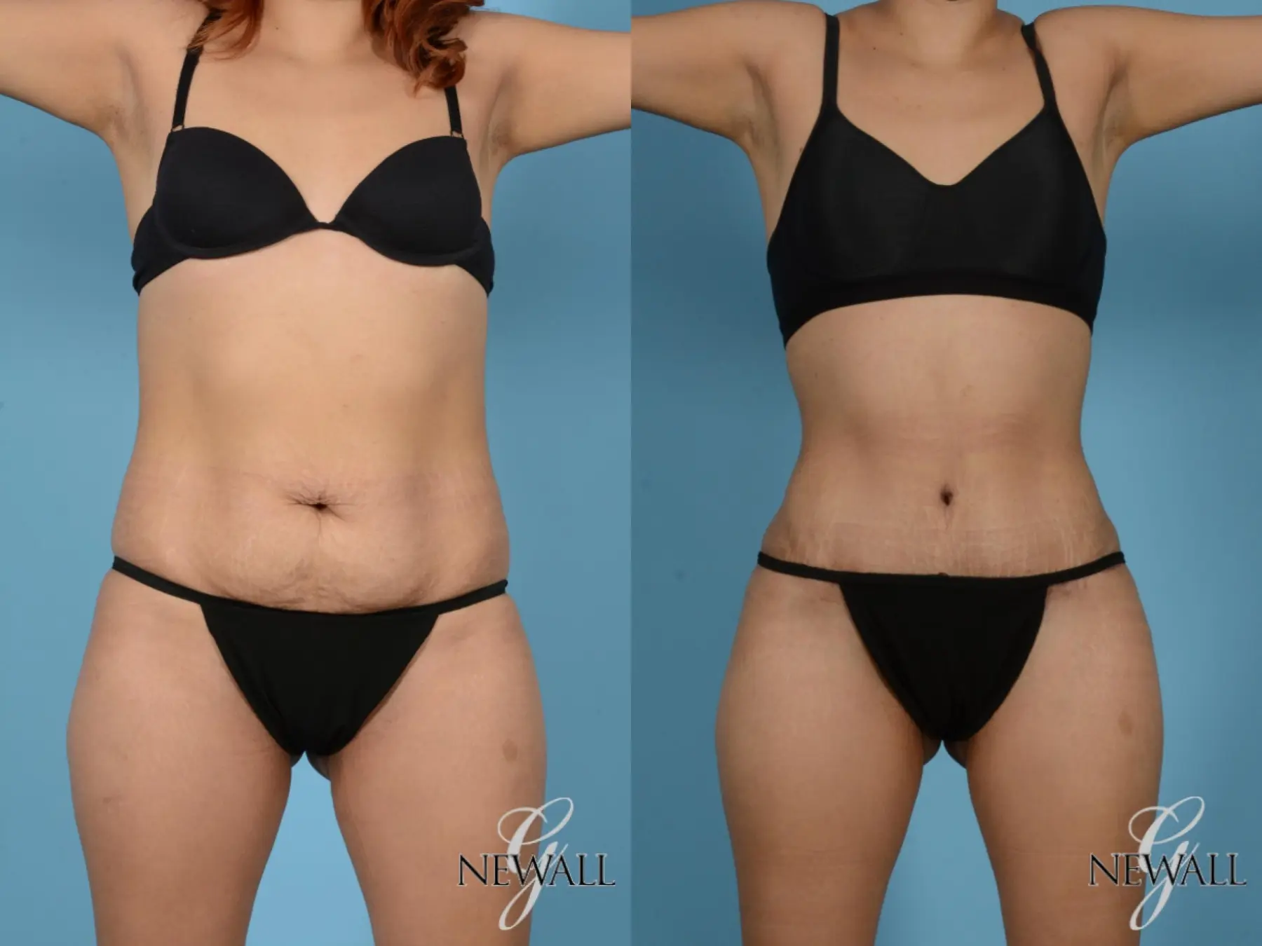 Tummy Tuck: Patient 16 - Before and After  