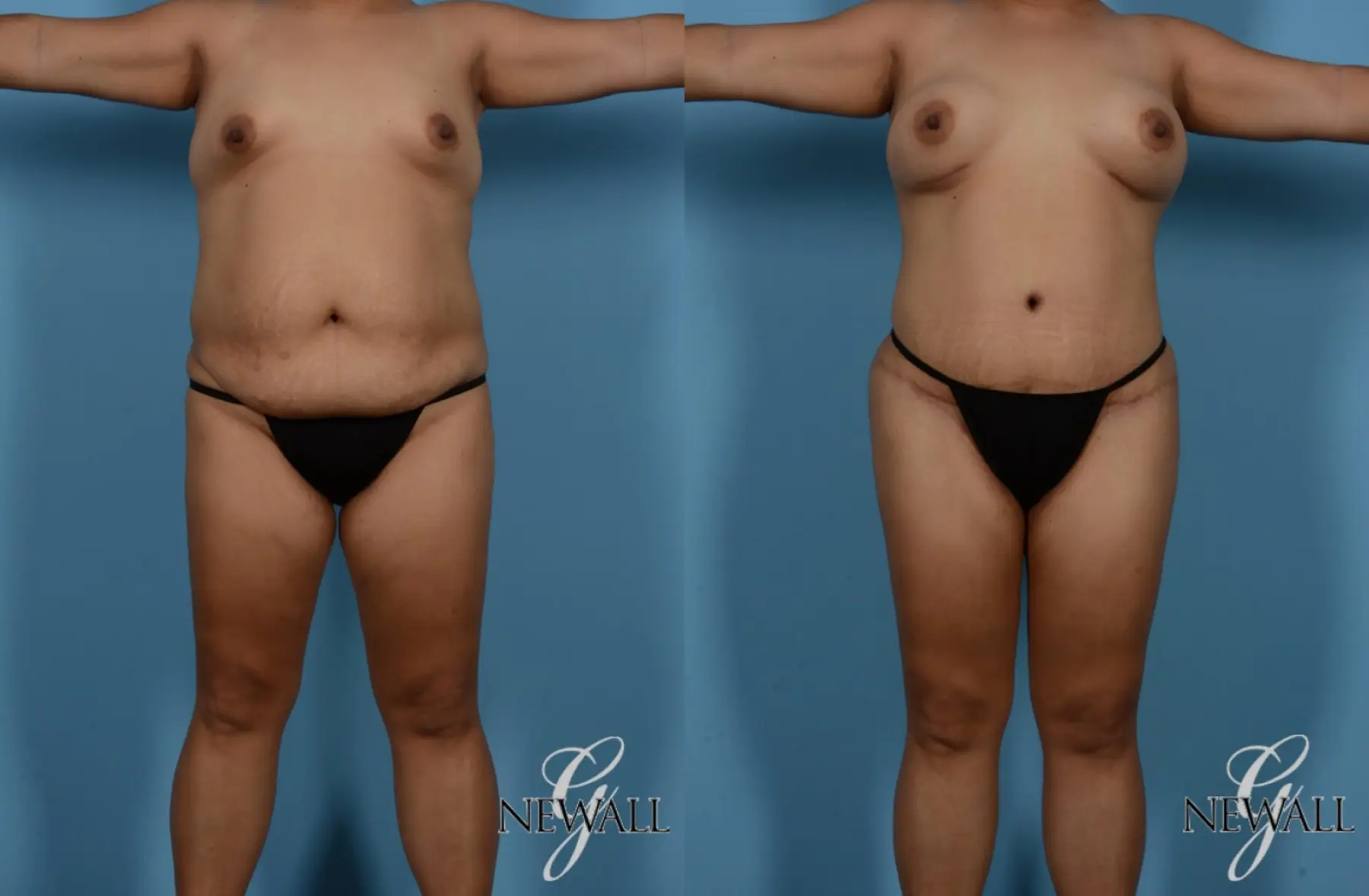 Tummy Tuck: Patient 4 - Before and After  