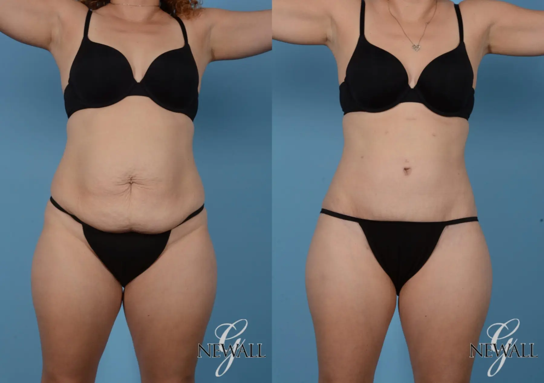 Tummy Tuck: Patient 5 - Before and After  