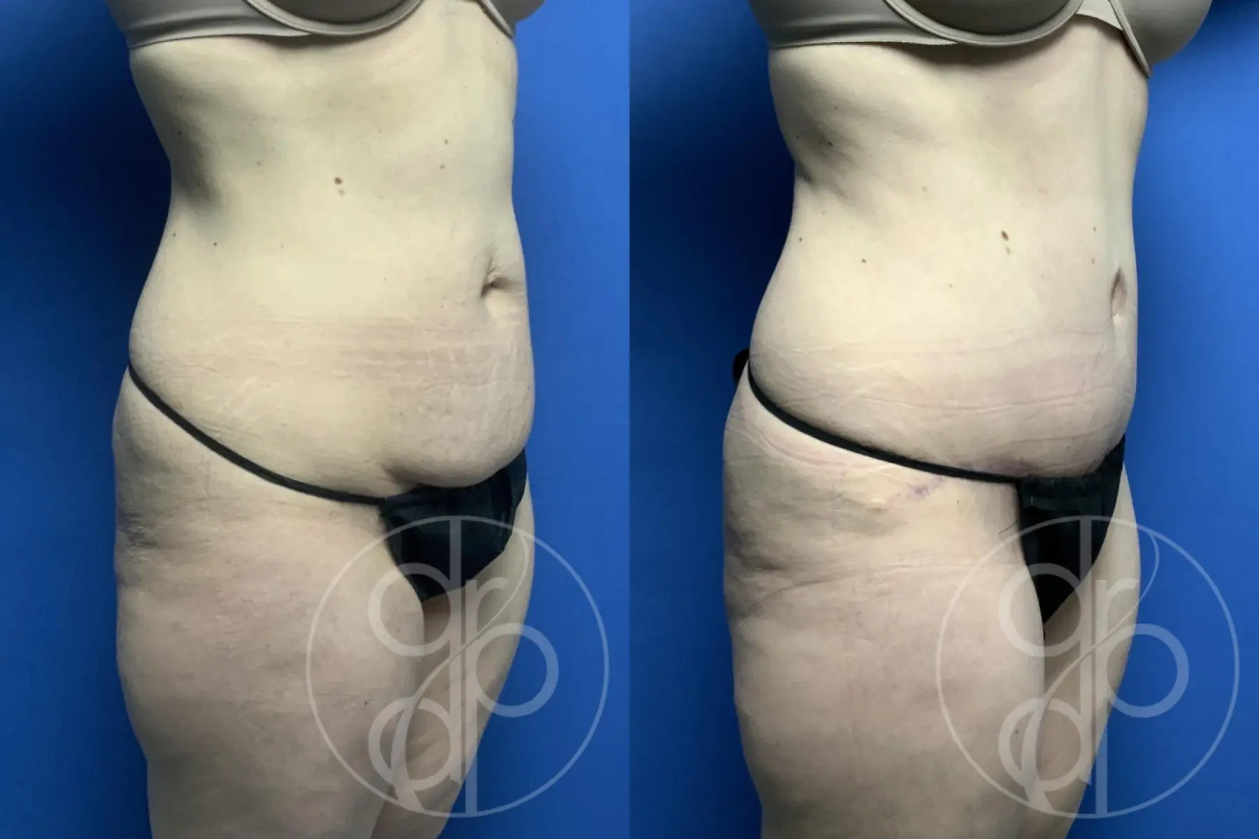 patient 12636 tummy tuck before and after result - Before and After 2