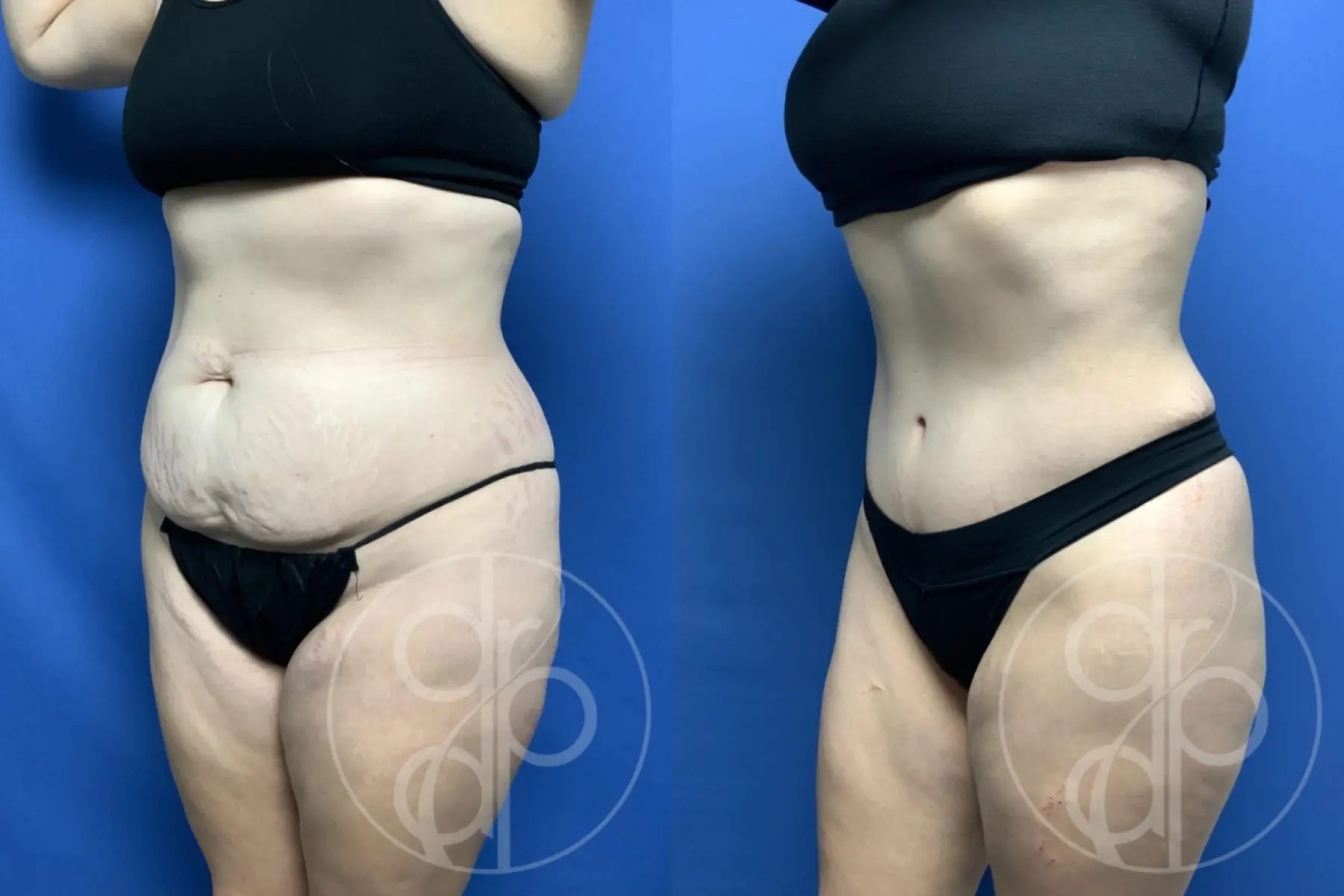 patient 12001 tummy tuck before and after result - Before and After 2
