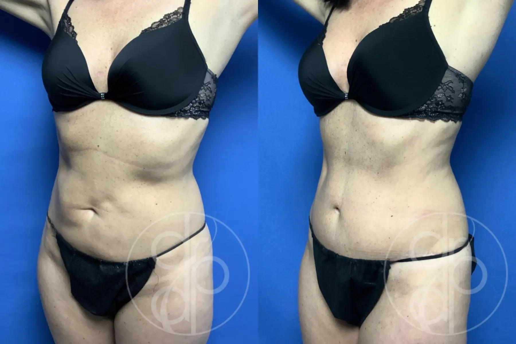 Abdominoplasty: Patient 39 - Before and After 4