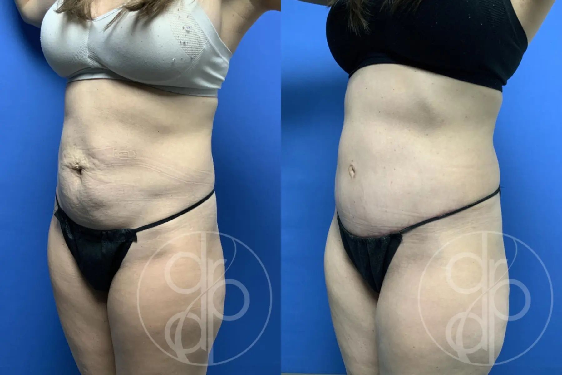 patient 12369 tummy tuck before and after result - Before and After 4