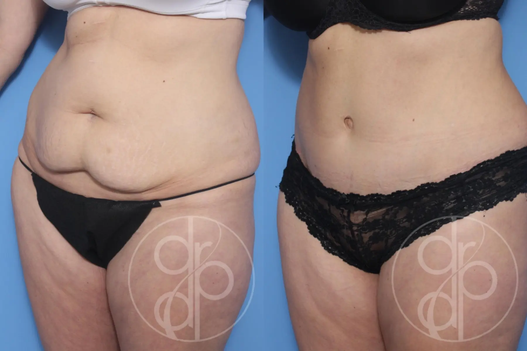 patient 12941 tummy tuck before and after result - Before and After 3