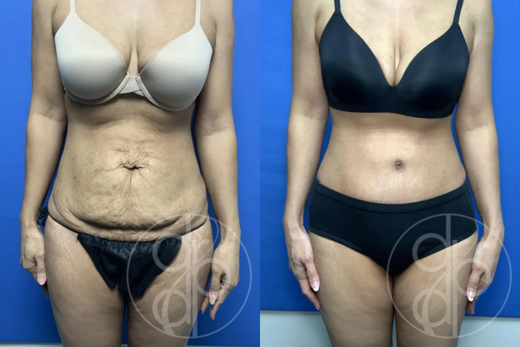 patient 13839 tummy tuck before and after result - Before and After 1