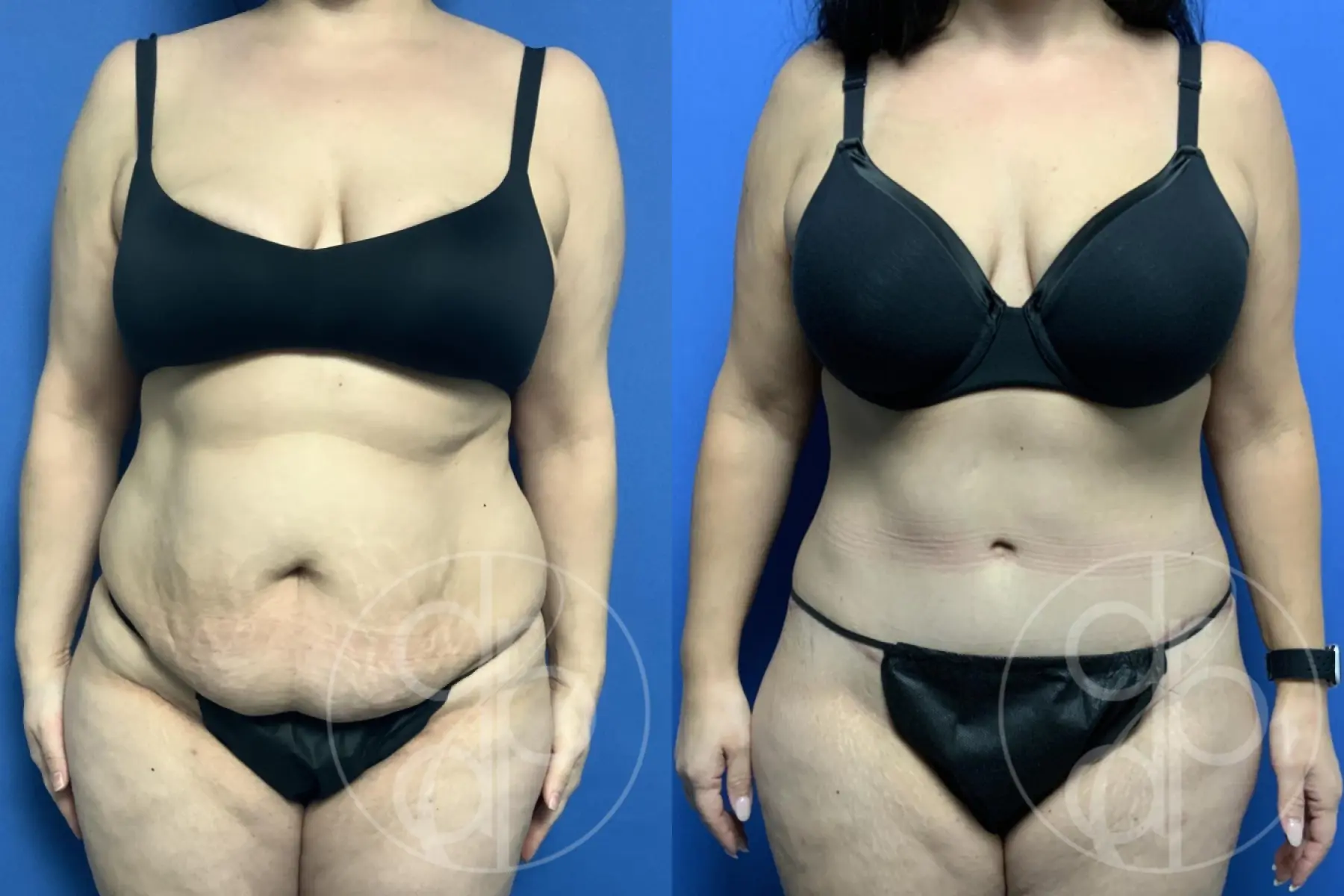 patient 13394 tummy tuck before and after result - Before and After