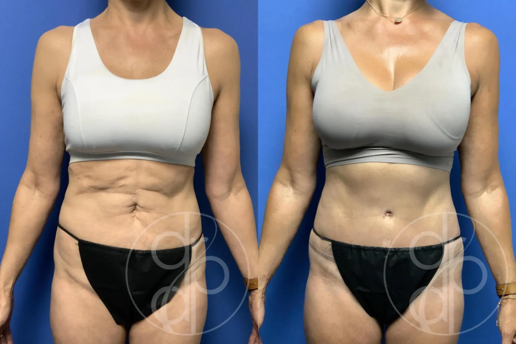 Abdominoplasty: Patient 42 - Before and After  