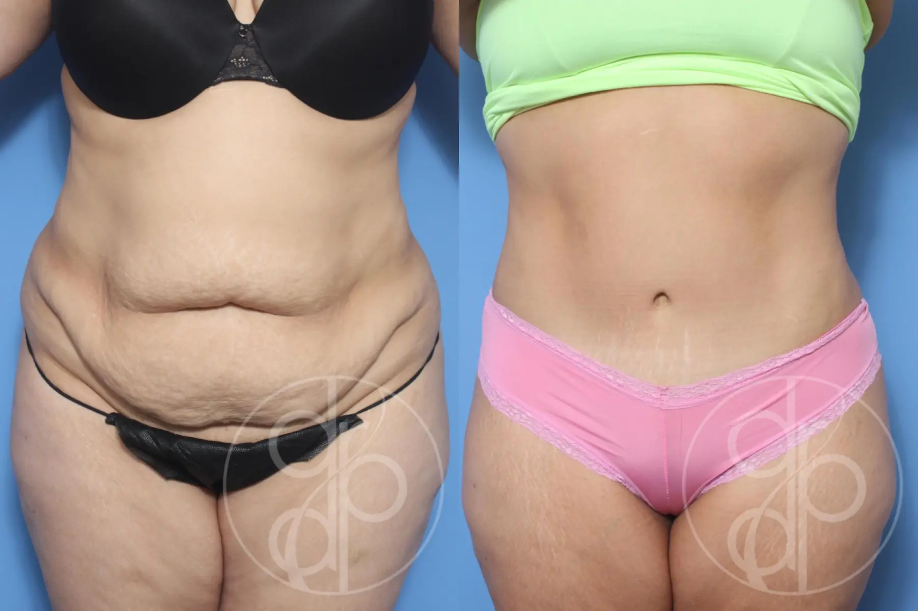 patient 12988 tummy tuck before and after result - Before and After 1