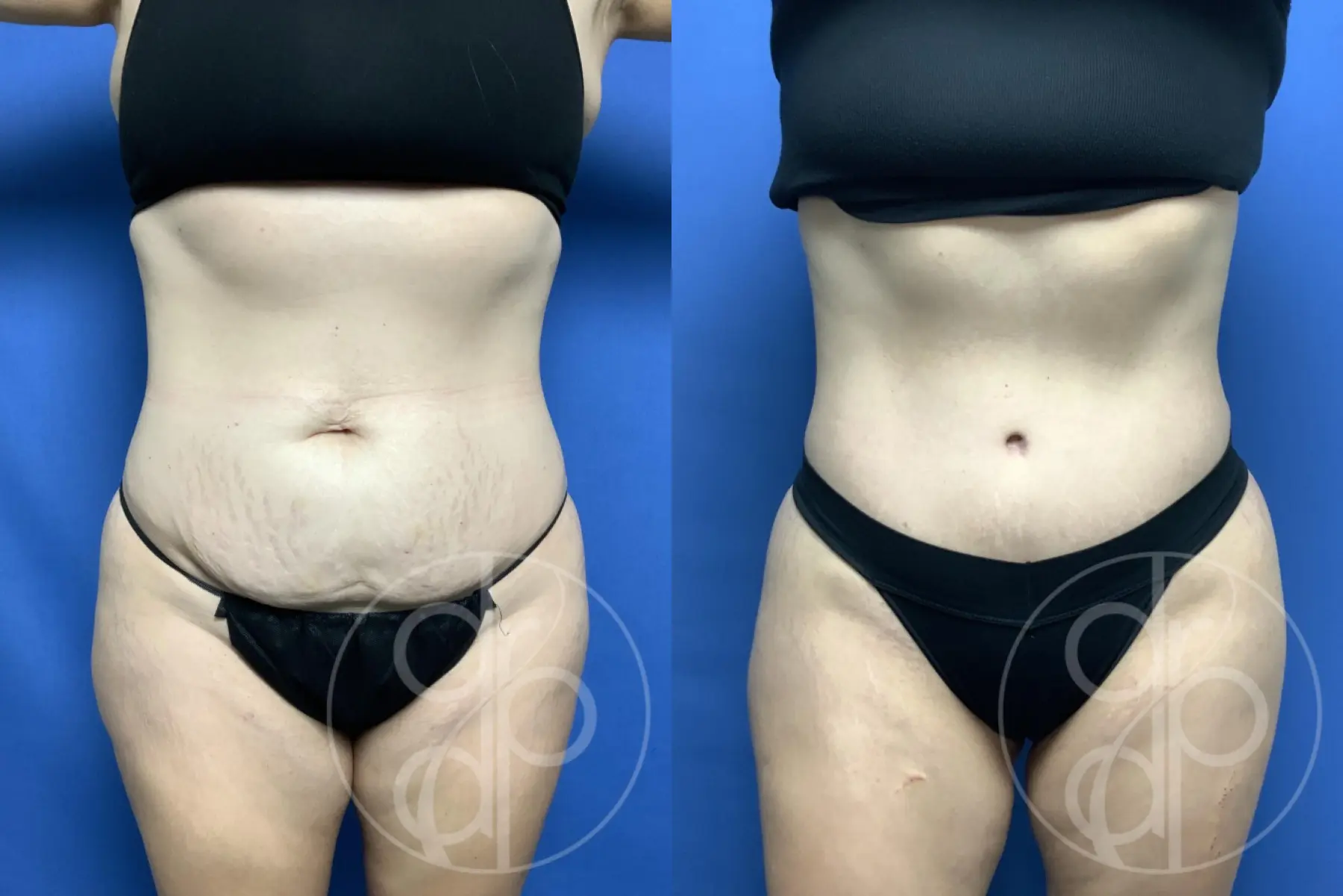patient 12001 tummy tuck before and after result - Before and After
