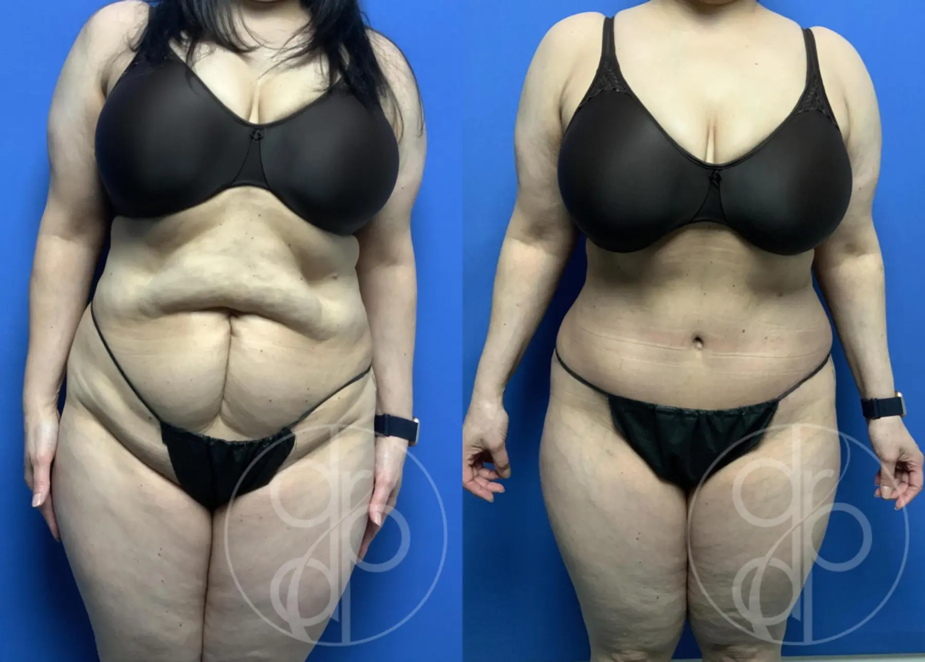 patient 12710 tummy tuck before and after result - Before and After 1