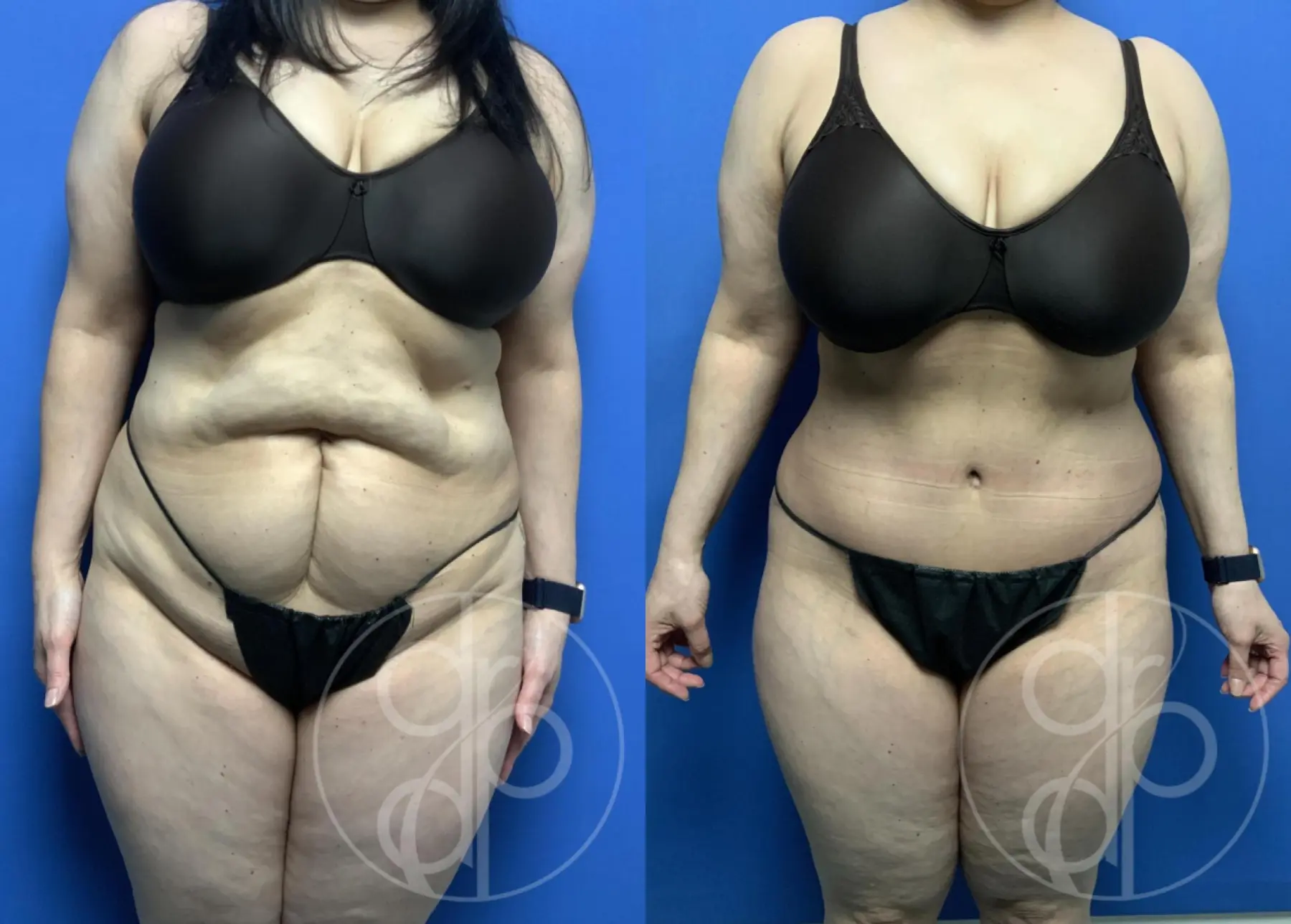 patient 12710 tummy tuck before and after result - Before and After