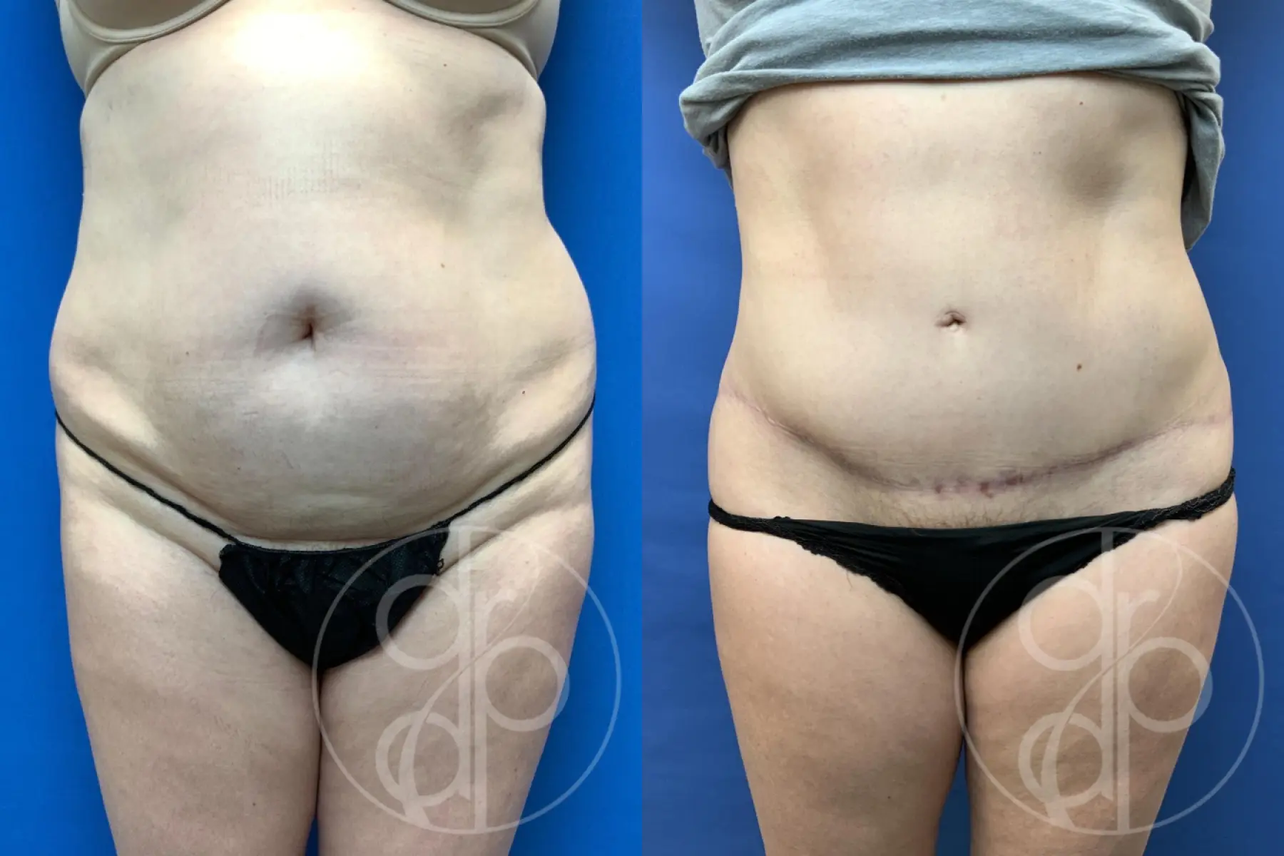 patient 10745 tummy tuck before and after result - Before and After 1