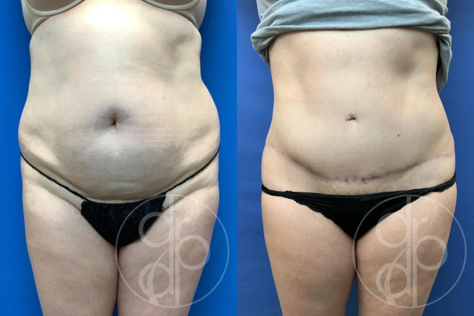 patient 10745 tummy tuck before and after result - Before and After