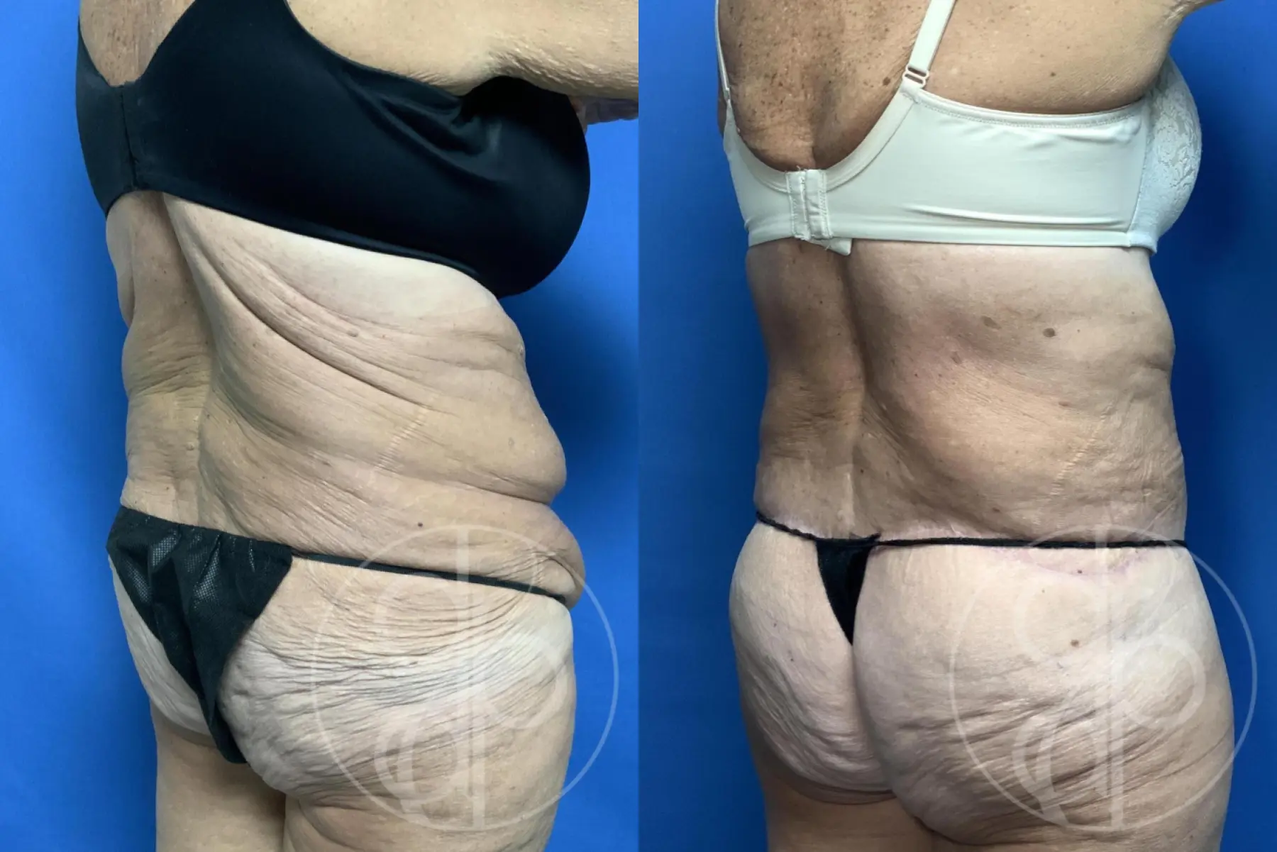Abdominoplasty: Patient 36 - Before and After 6