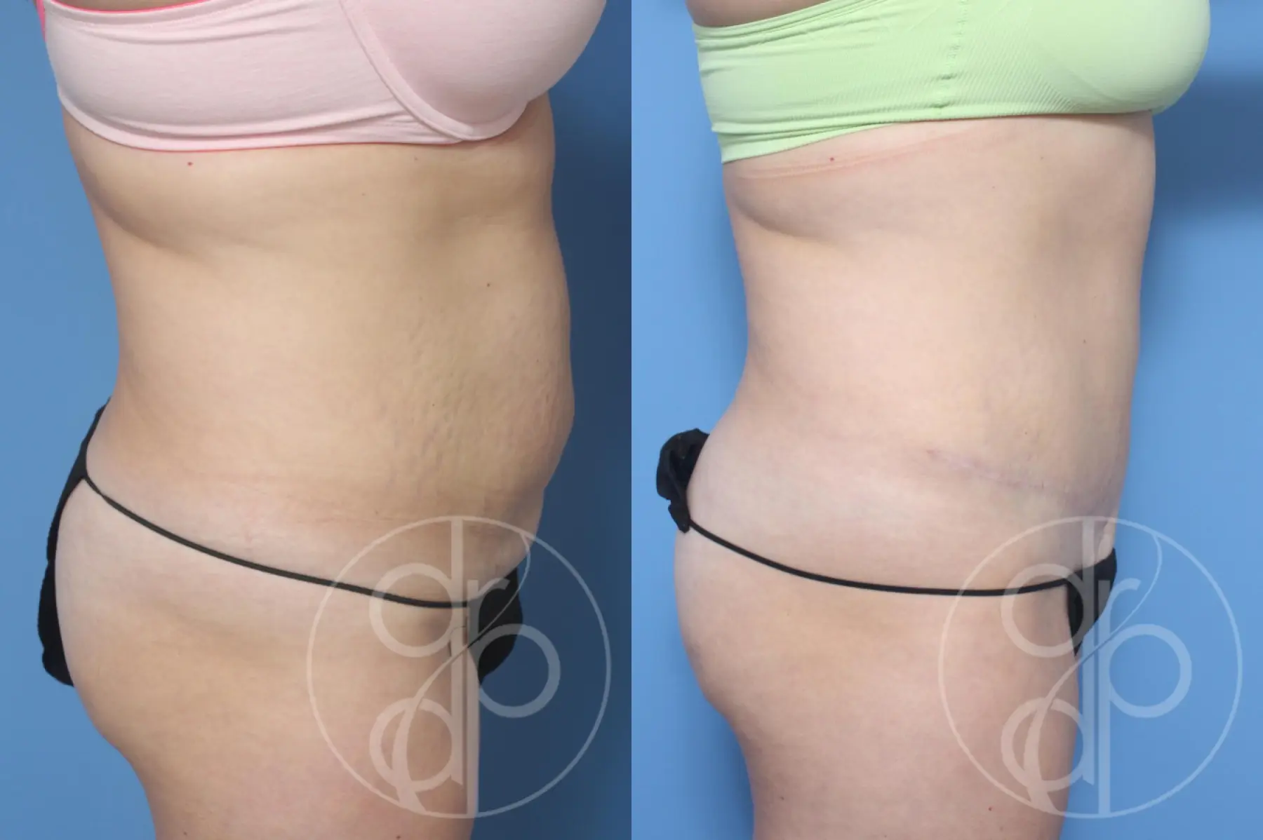 patient 13144 tummy tuck before and after result - Before and After 2
