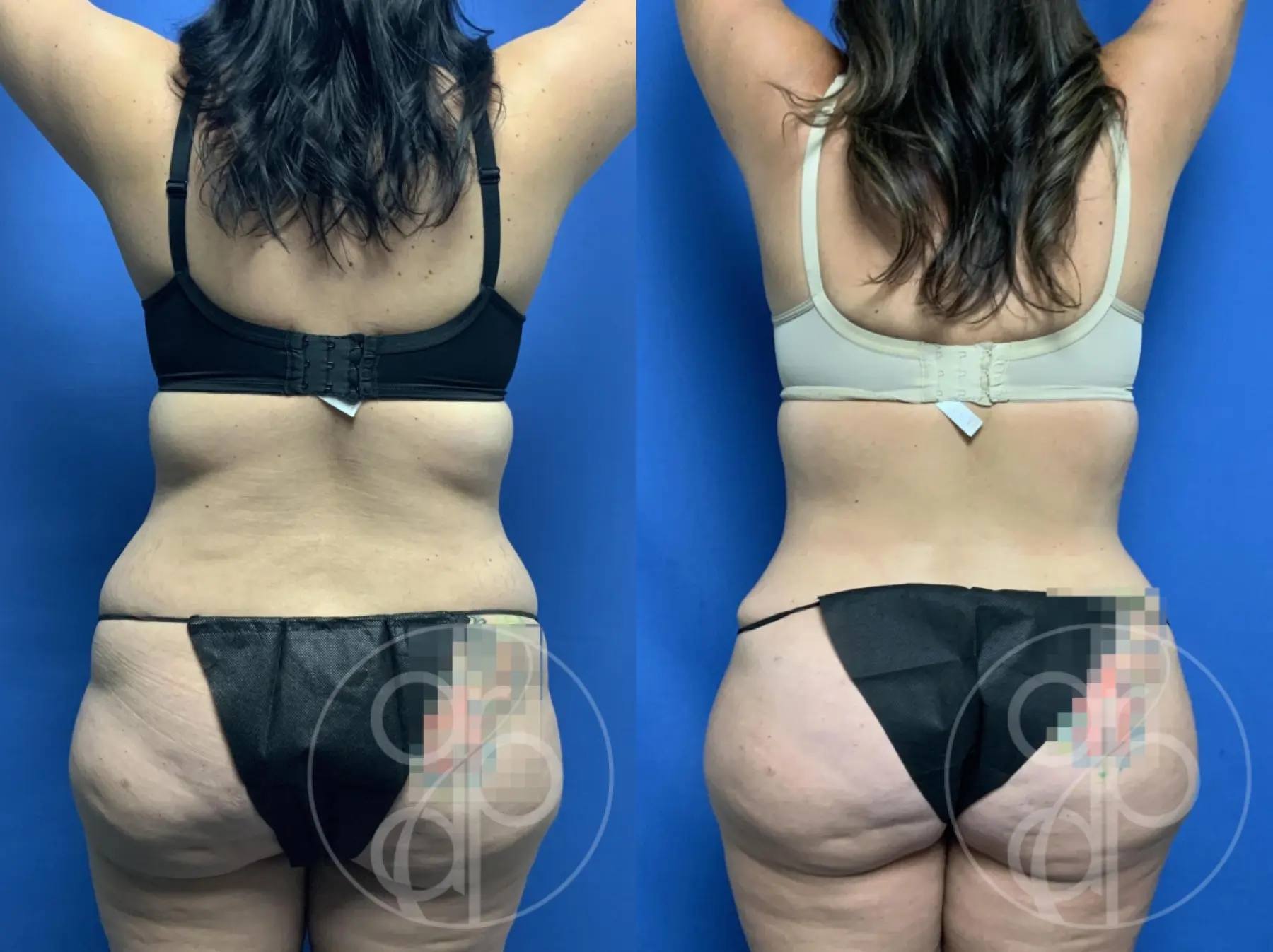 patient 12668 tummy tuck before and after result - Before and After 4