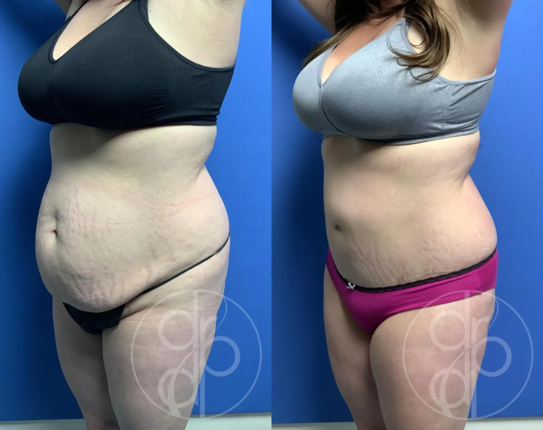 patient 12093 tummy tuck before and after result - Before and After 2