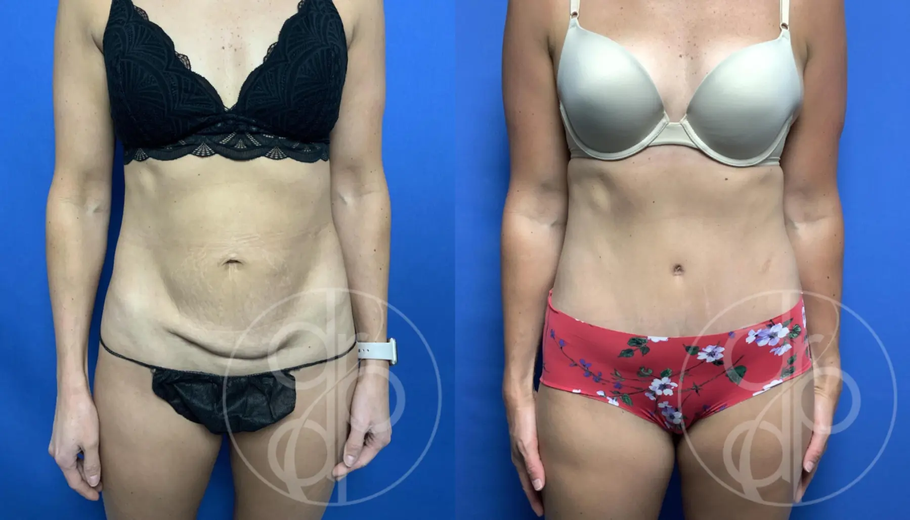 patient 11988 tummy tuck before and after result - Before and After