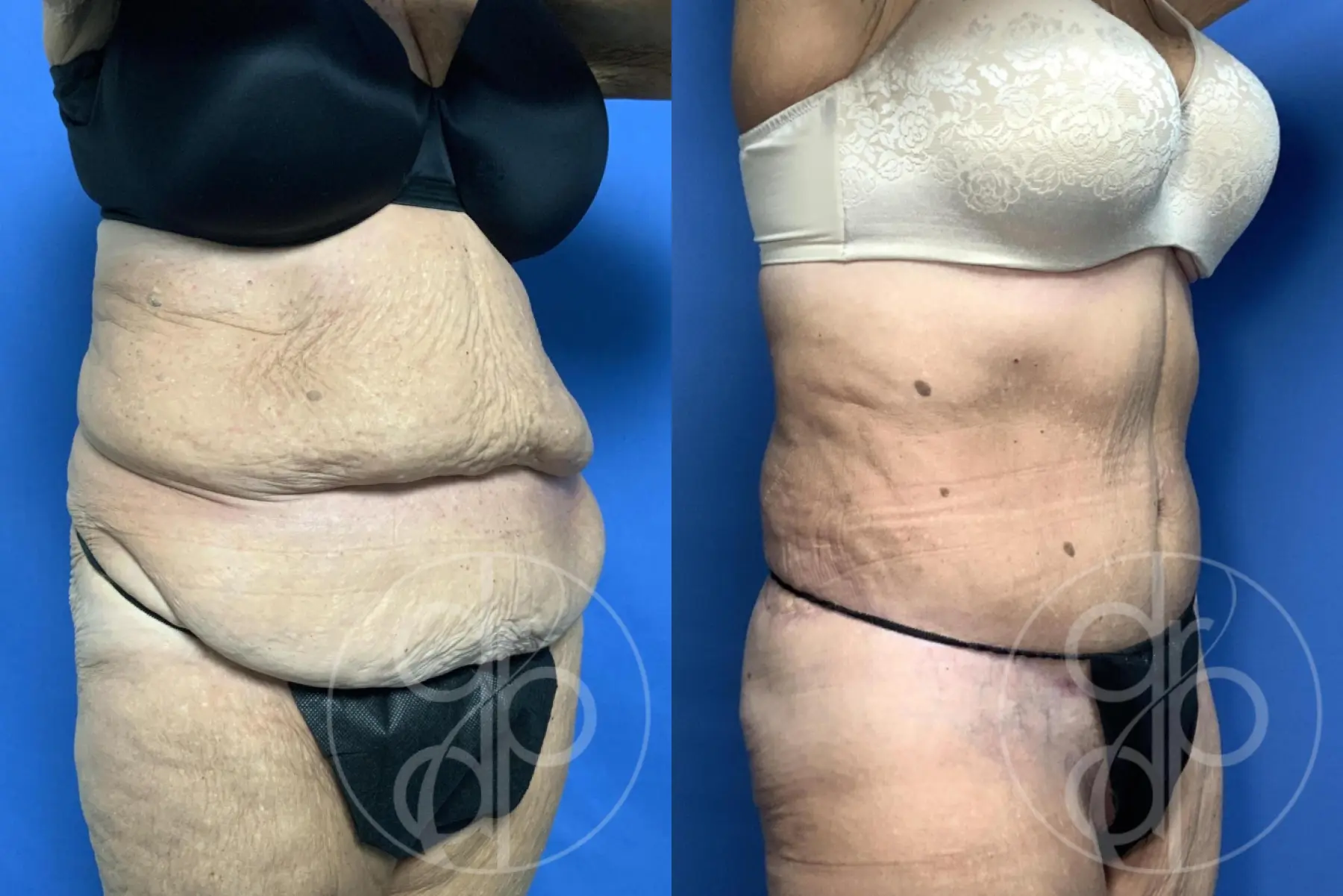 Abdominoplasty: Patient 36 - Before and After 7