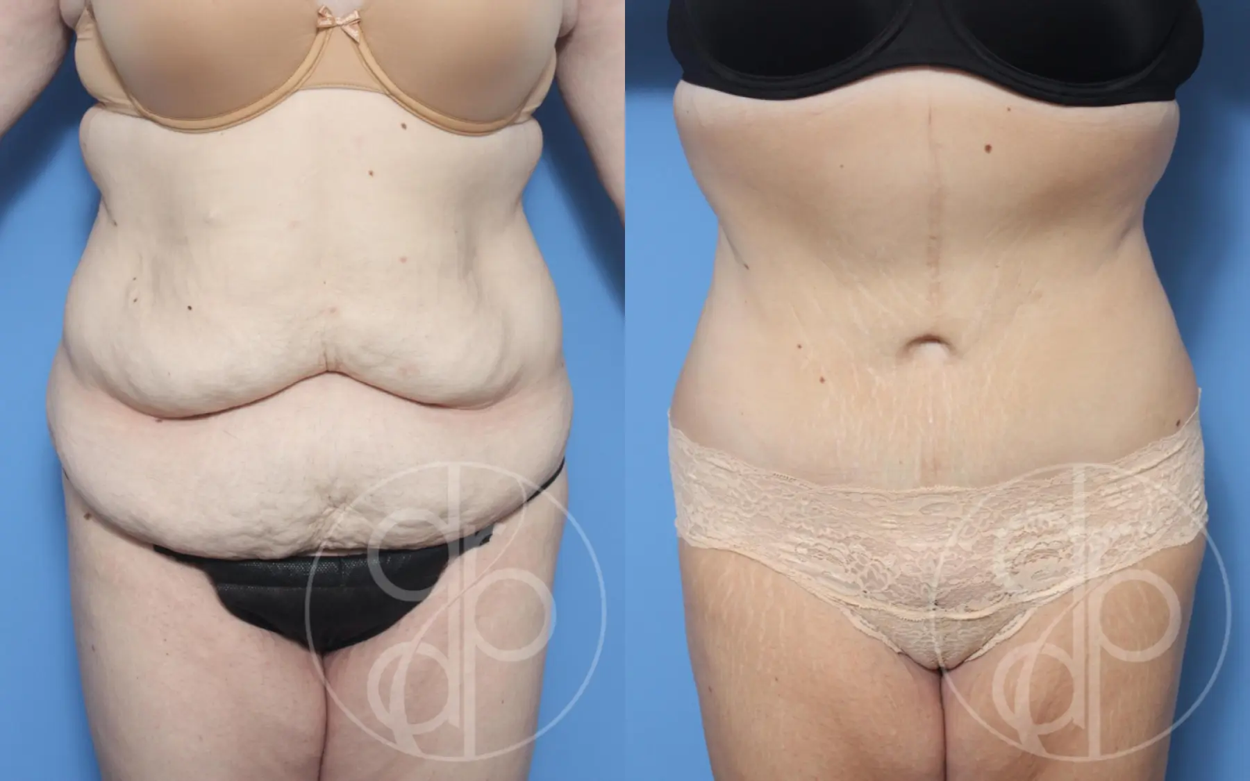 patient 13274 tummy tuck before and after result - Before and After 1