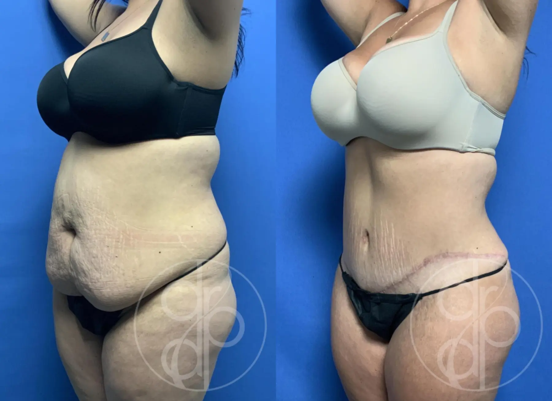 patient 12668 tummy tuck before and after result - Before and After 3