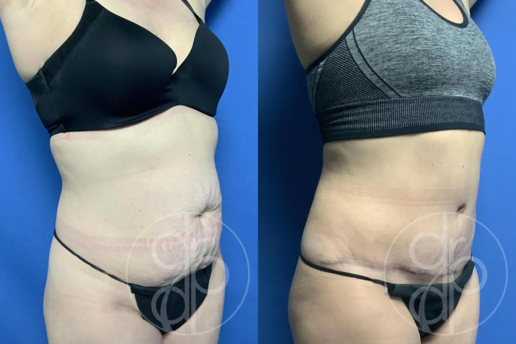 Abdominoplasty: Patient 30 - Before and After 3