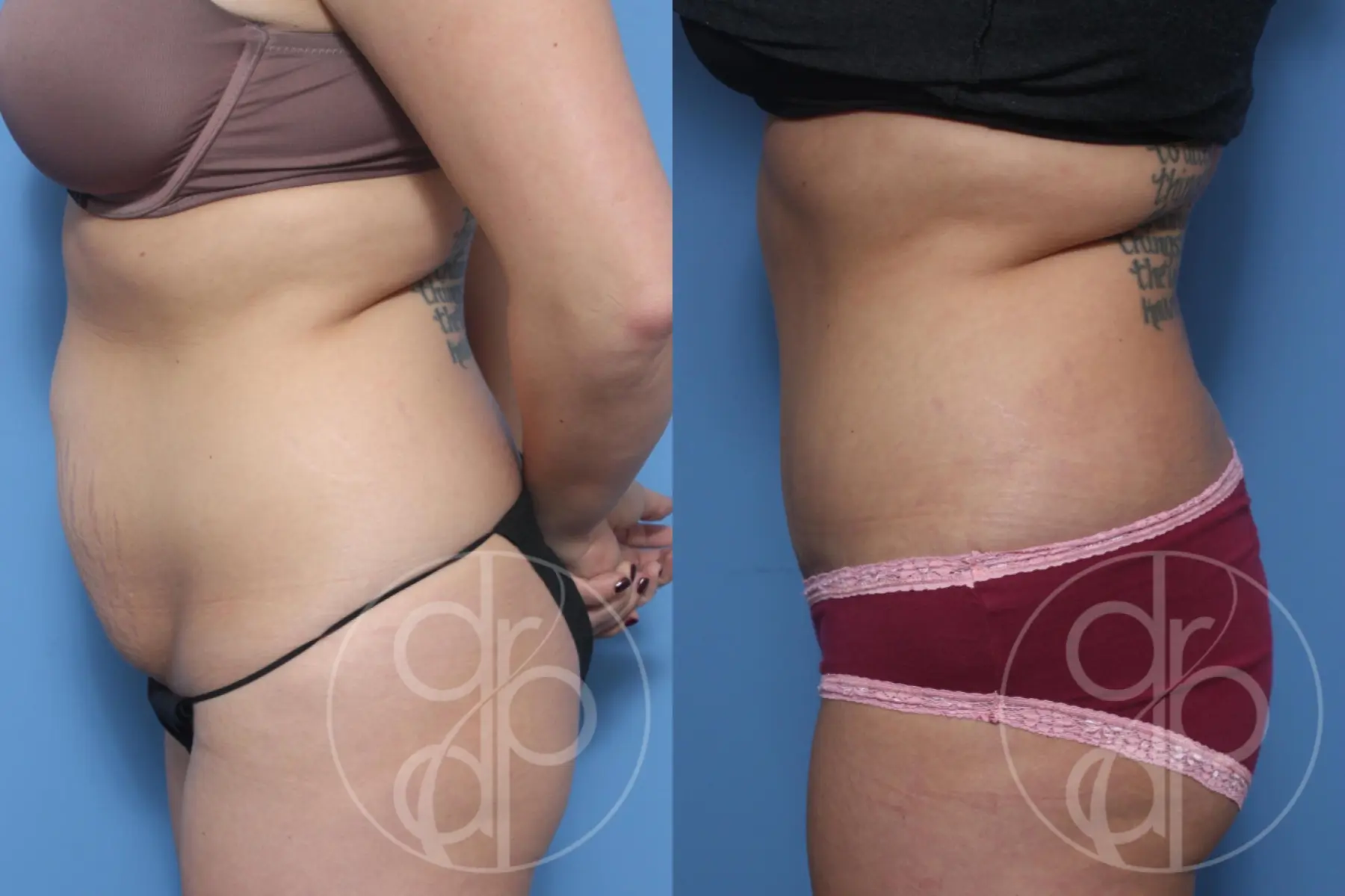 patient 11862 tummy tuck before and after result - Before and After 2