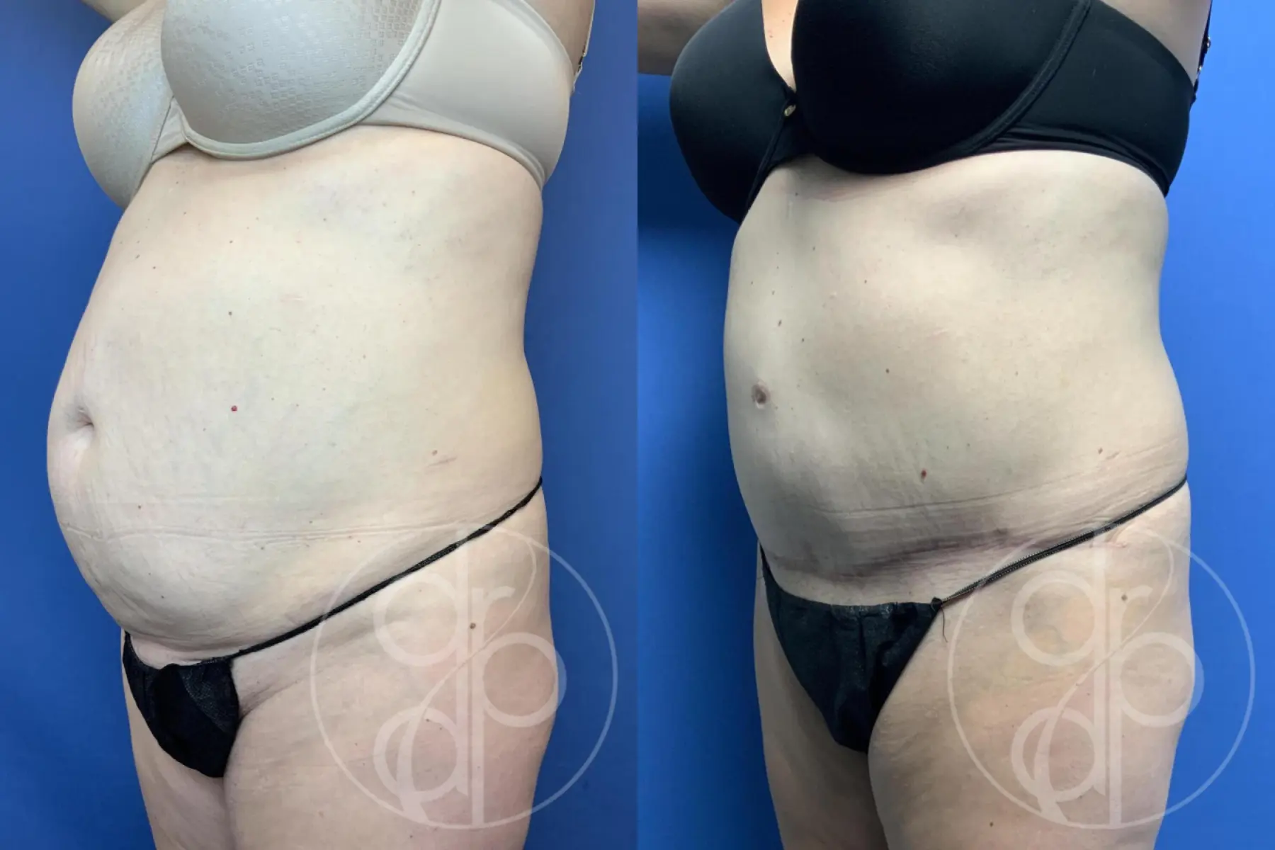 Abdominoplasty: Patient 40 - Before and After 3