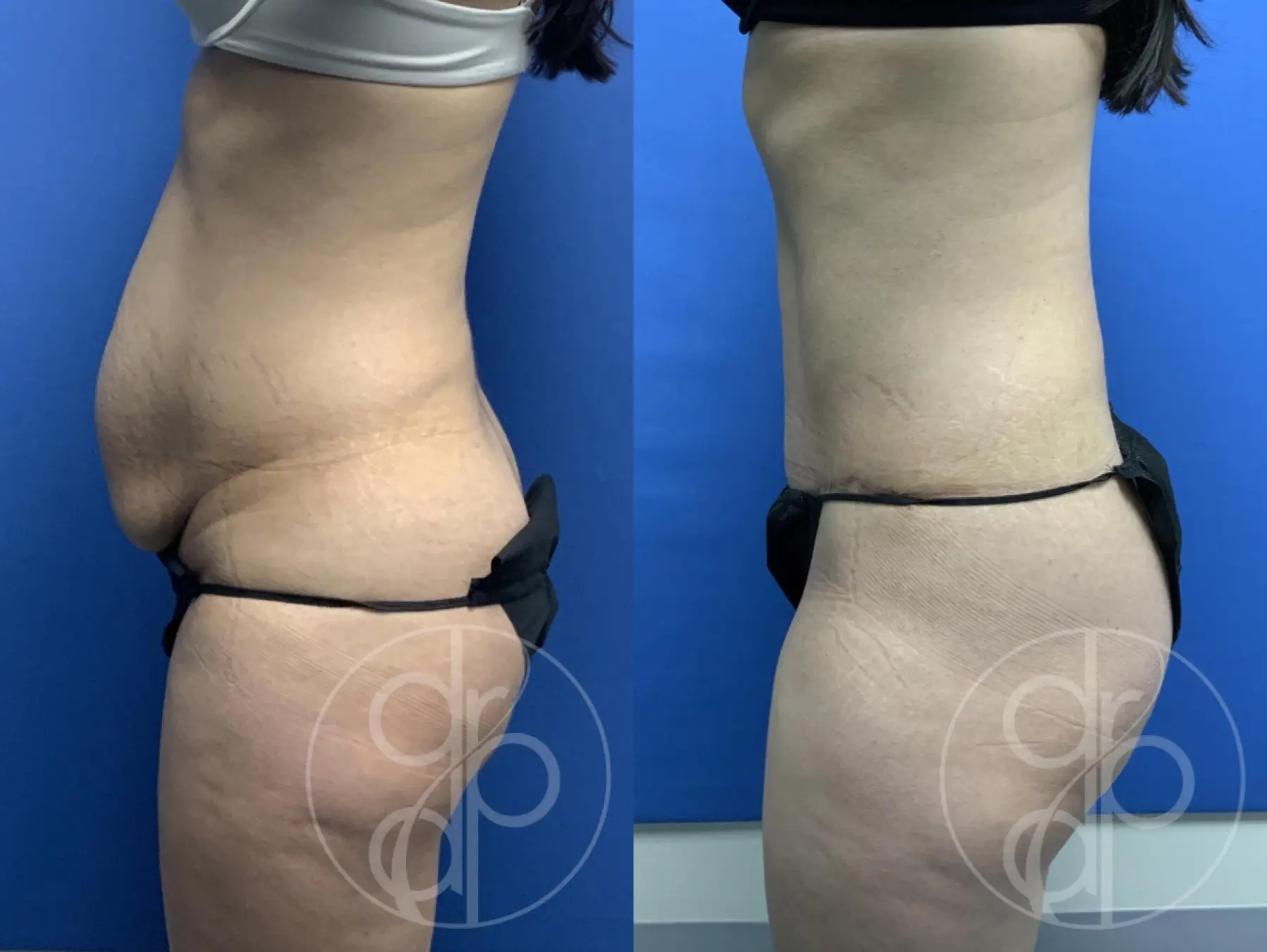 patient 13353 tummy tuck before and after result - Before and After 2