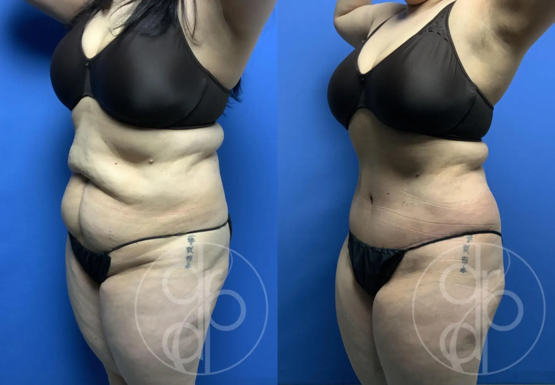 patient 12710 tummy tuck before and after result - Before and After 3