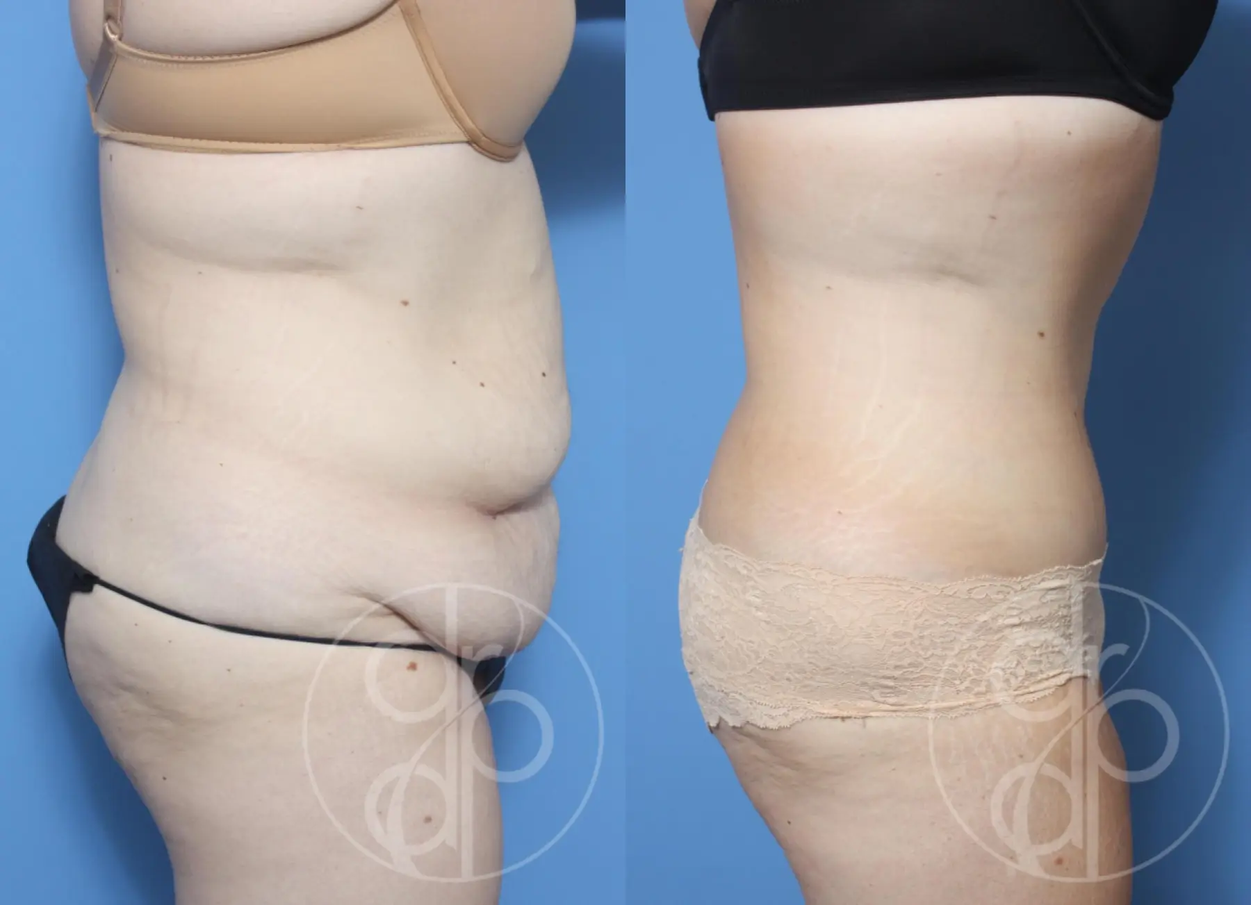 patient 13274 tummy tuck before and after result - Before and After 2