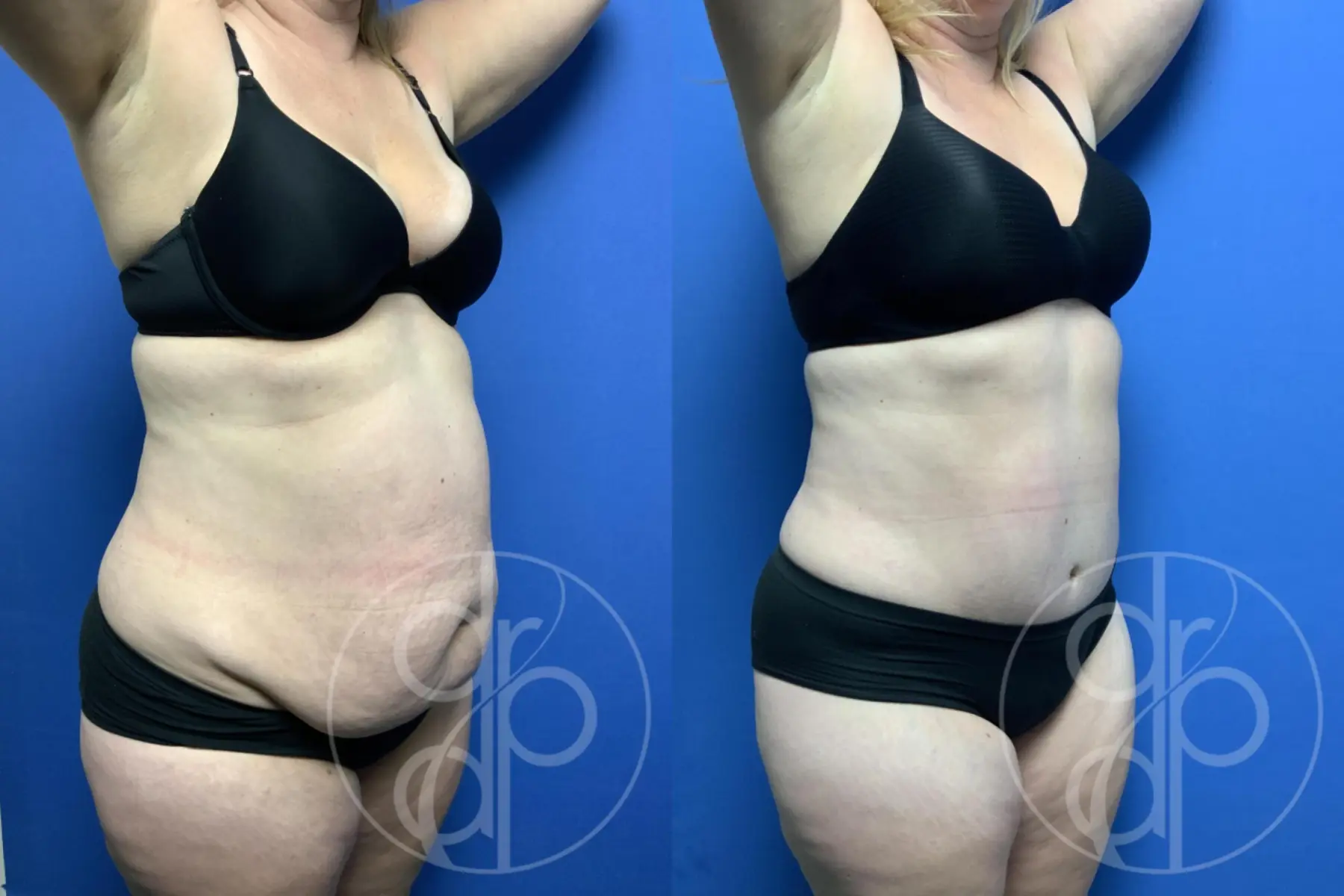 patient 10677 tummy tuck before and after result - Before and After 2