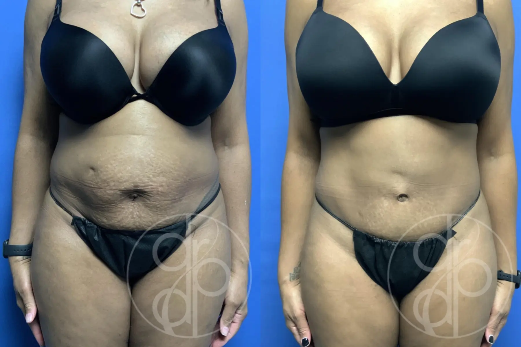 patient 13351 tummy tuck before and after result - Before and After 1