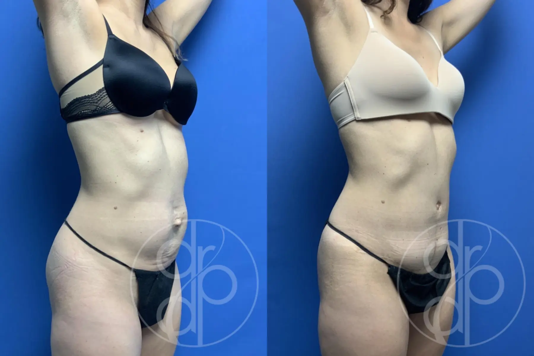 patient 12437 tummy tuck before and after result - Before and After 3