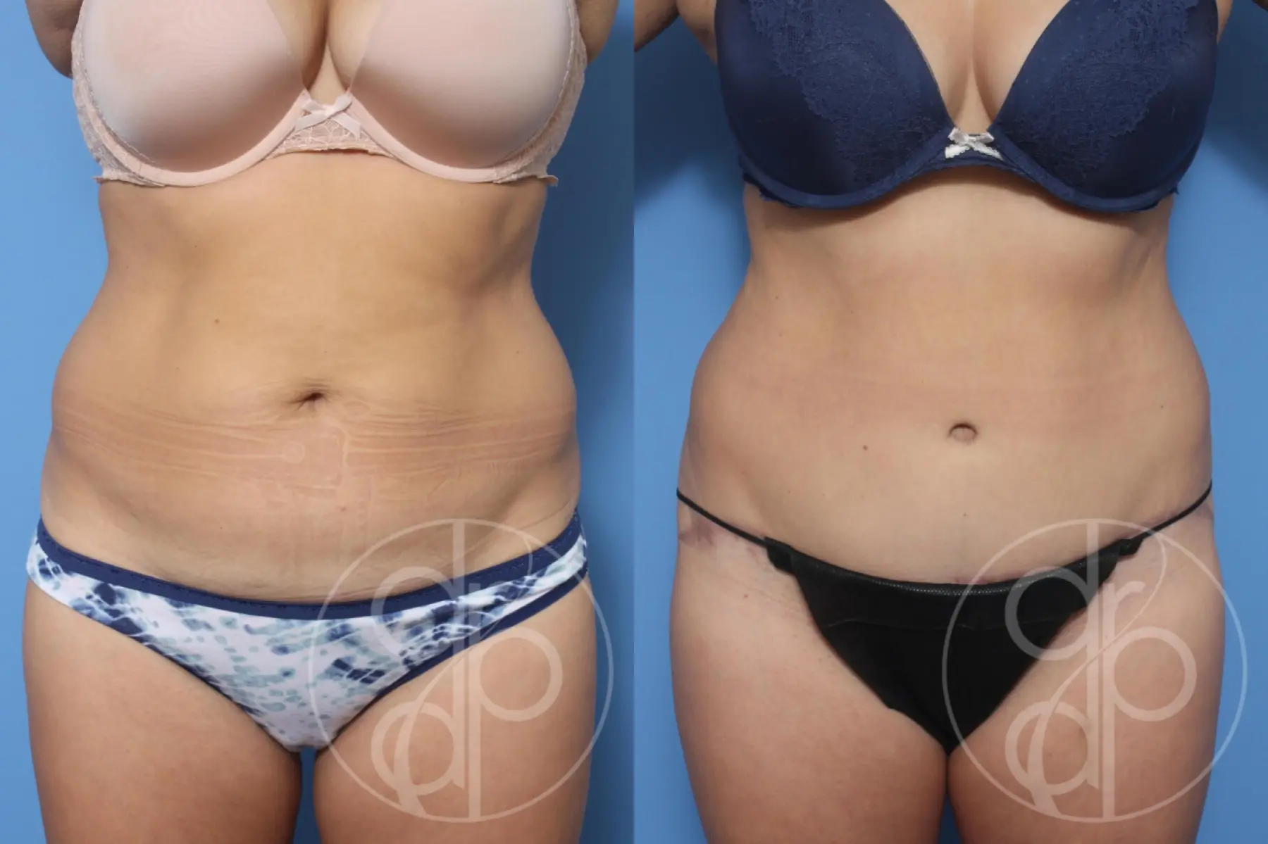 patient 13228 tummy tuck before and after result - Before and After 1