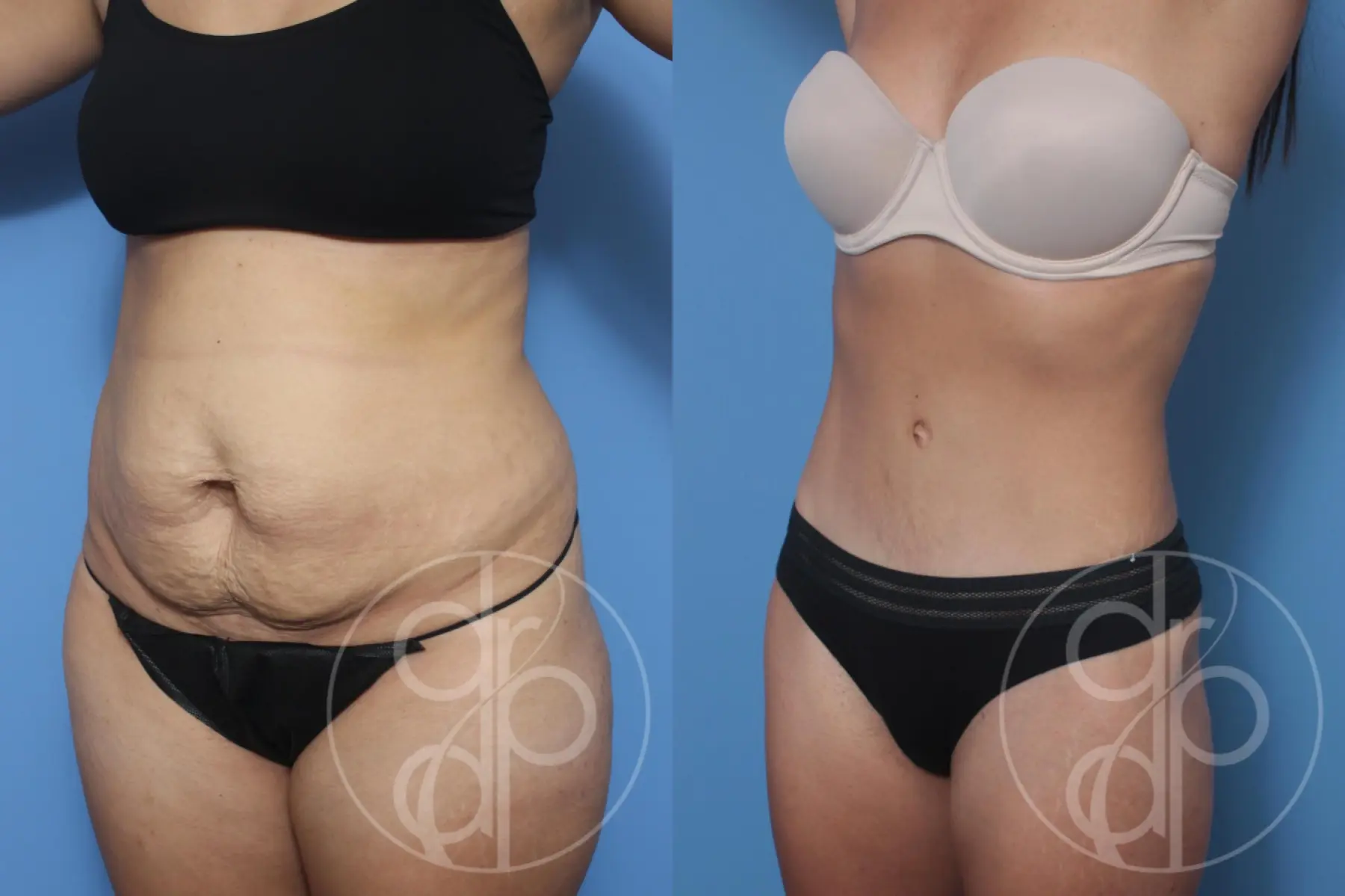 patient 10109 tummy tuck before and after result - Before and After 2