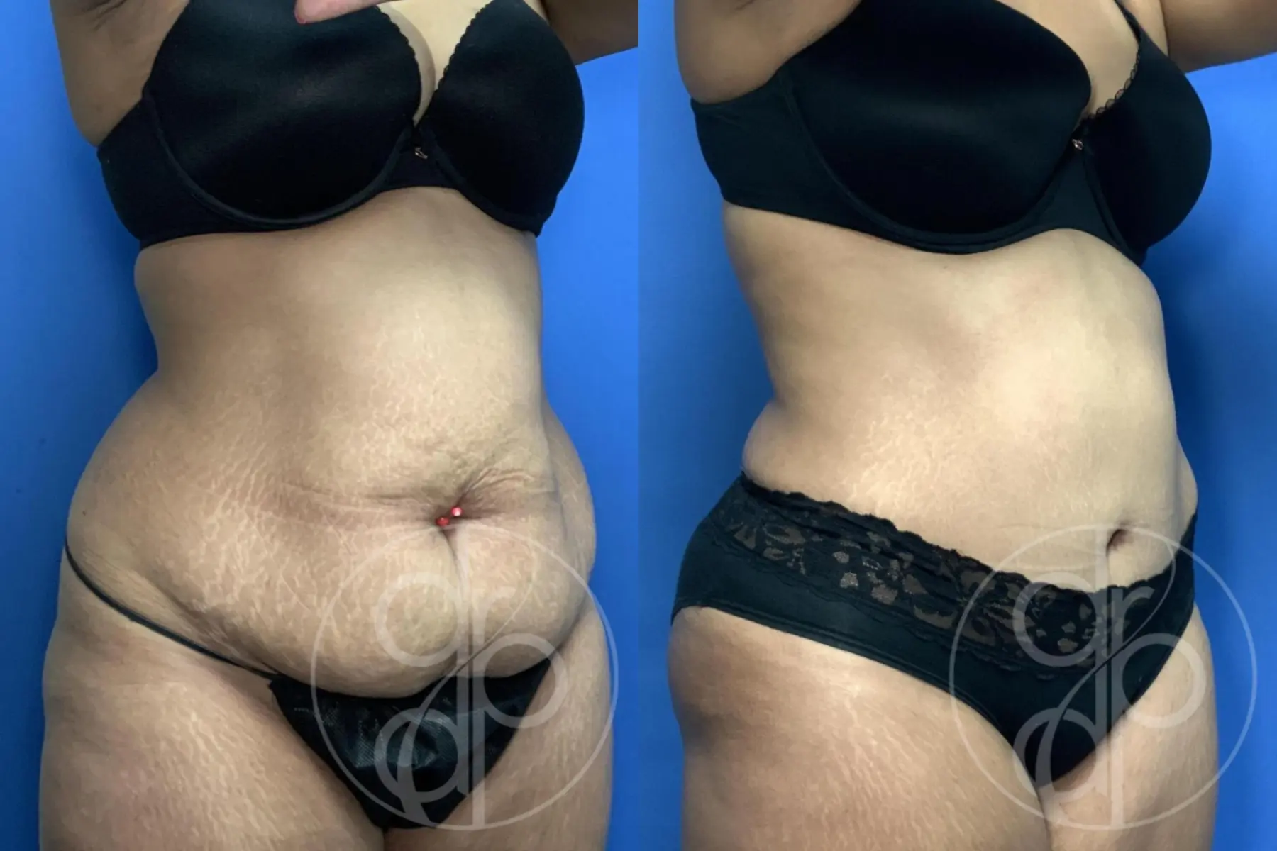 Abdominoplasty: Patient 38 - Before and After 4