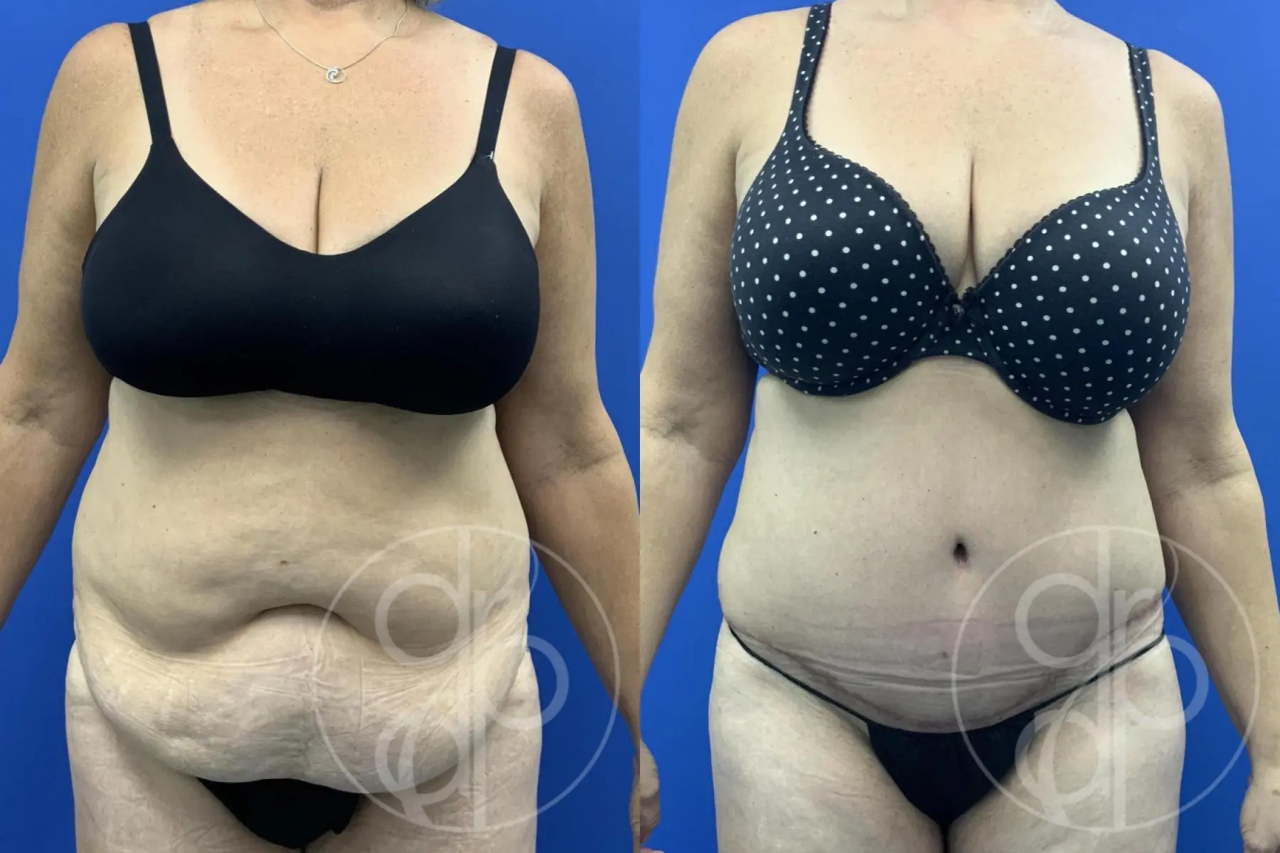 Abdominoplasty: Patient 41 - Before and After  