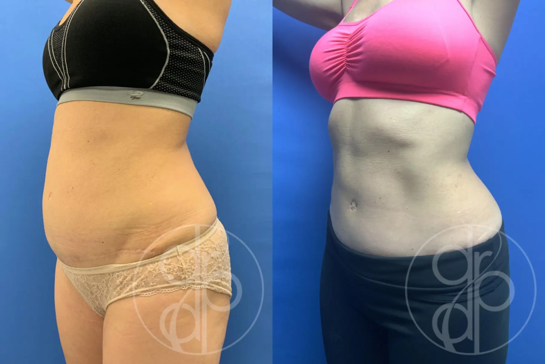 patient 10601 tummy tuck before and after result - Before and After 3