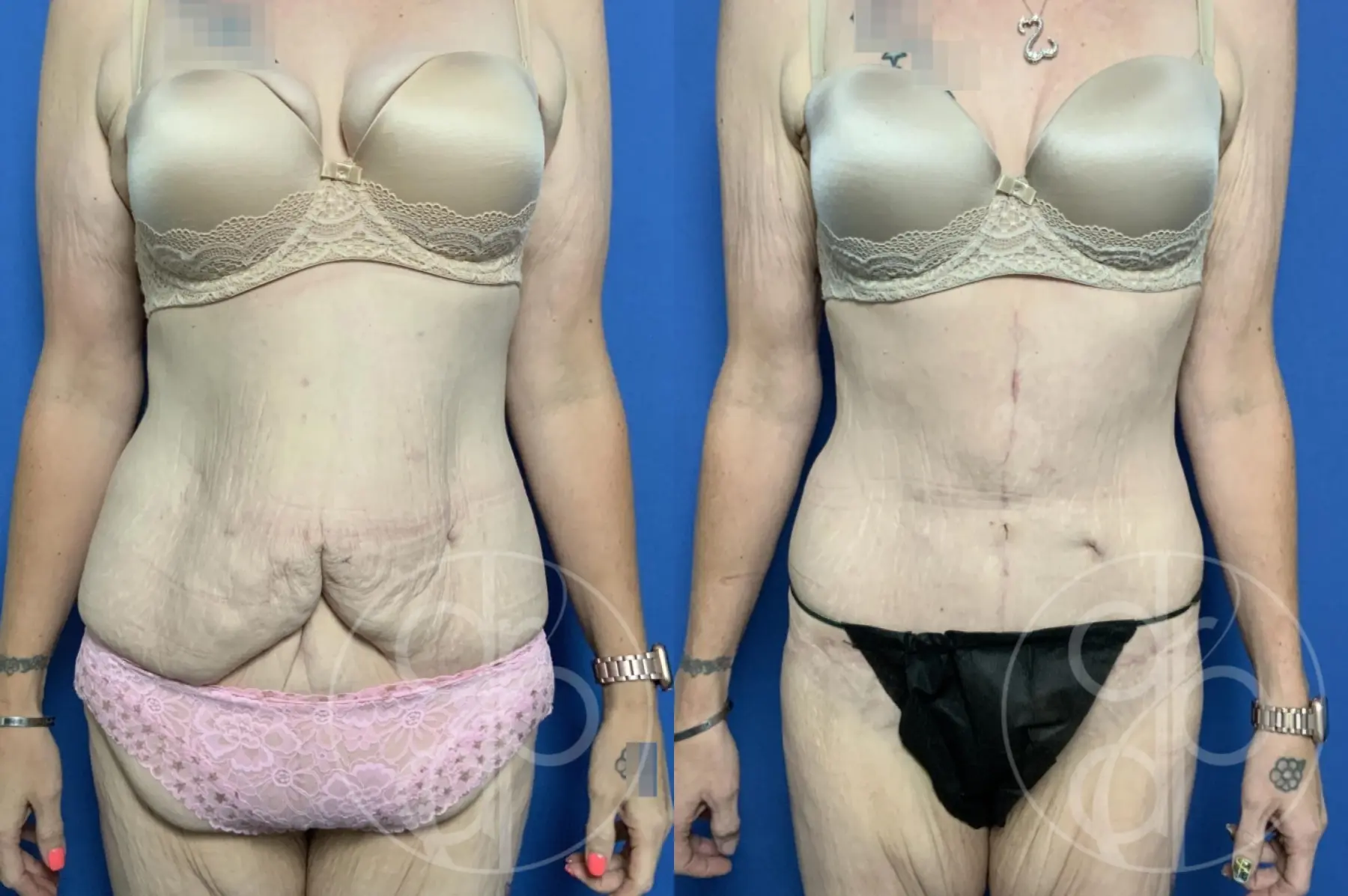 patient 12189 panniculectomy before and after result - Before and After