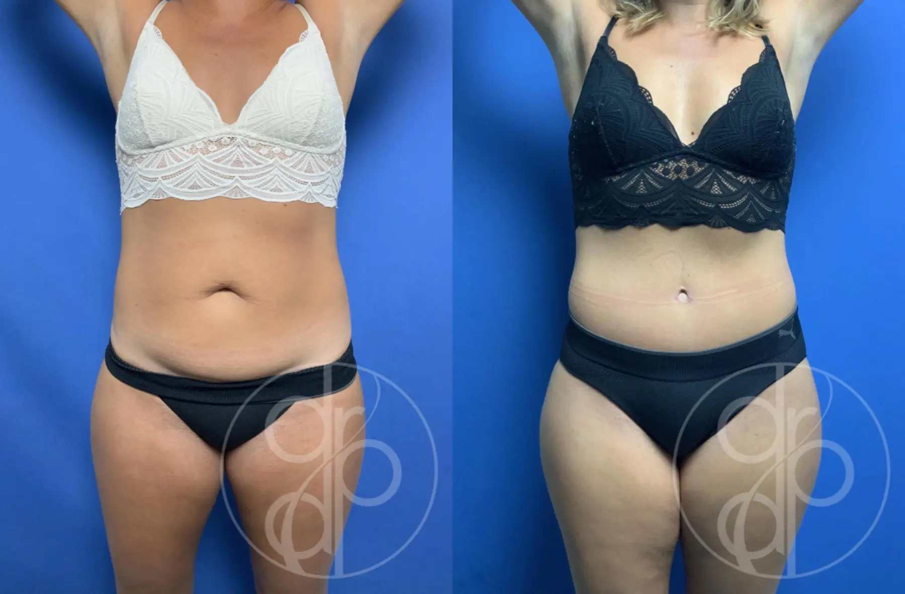 Abdominoplasty: Patient 8 - Before and After  
