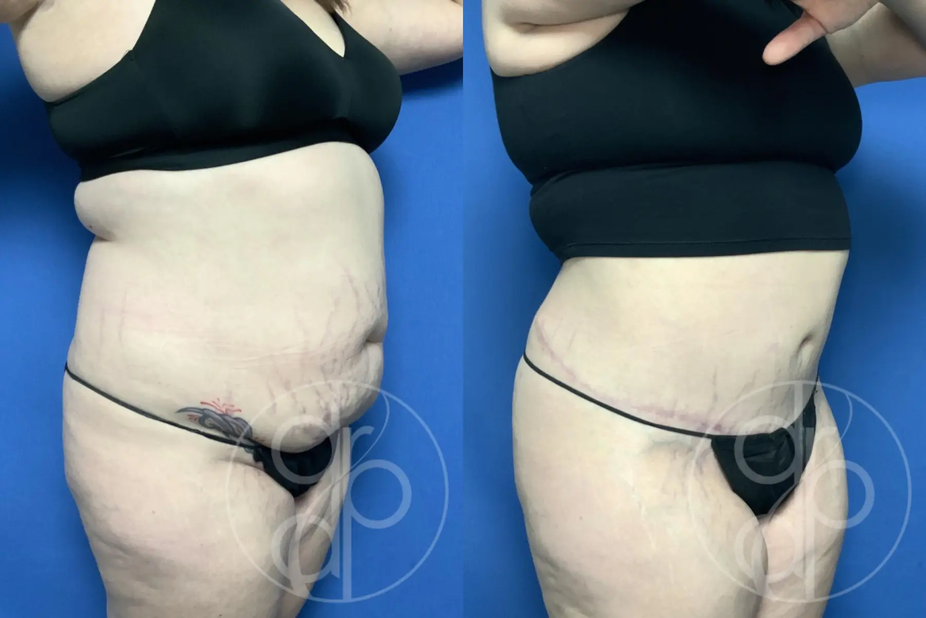 patient 13377 tummy tuck before and after result - Before and After 2