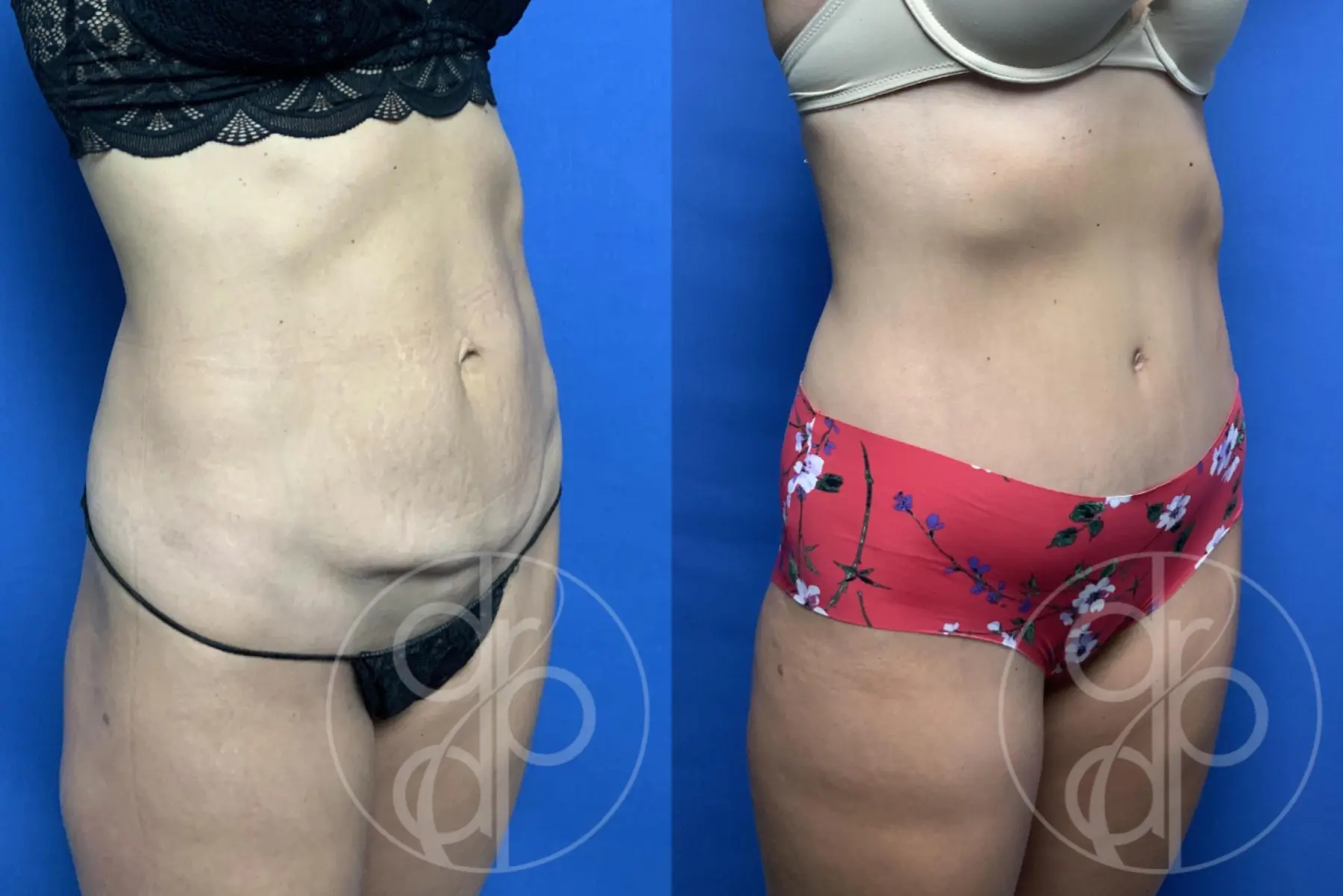 patient 11988 tummy tuck before and after result - Before and After 2