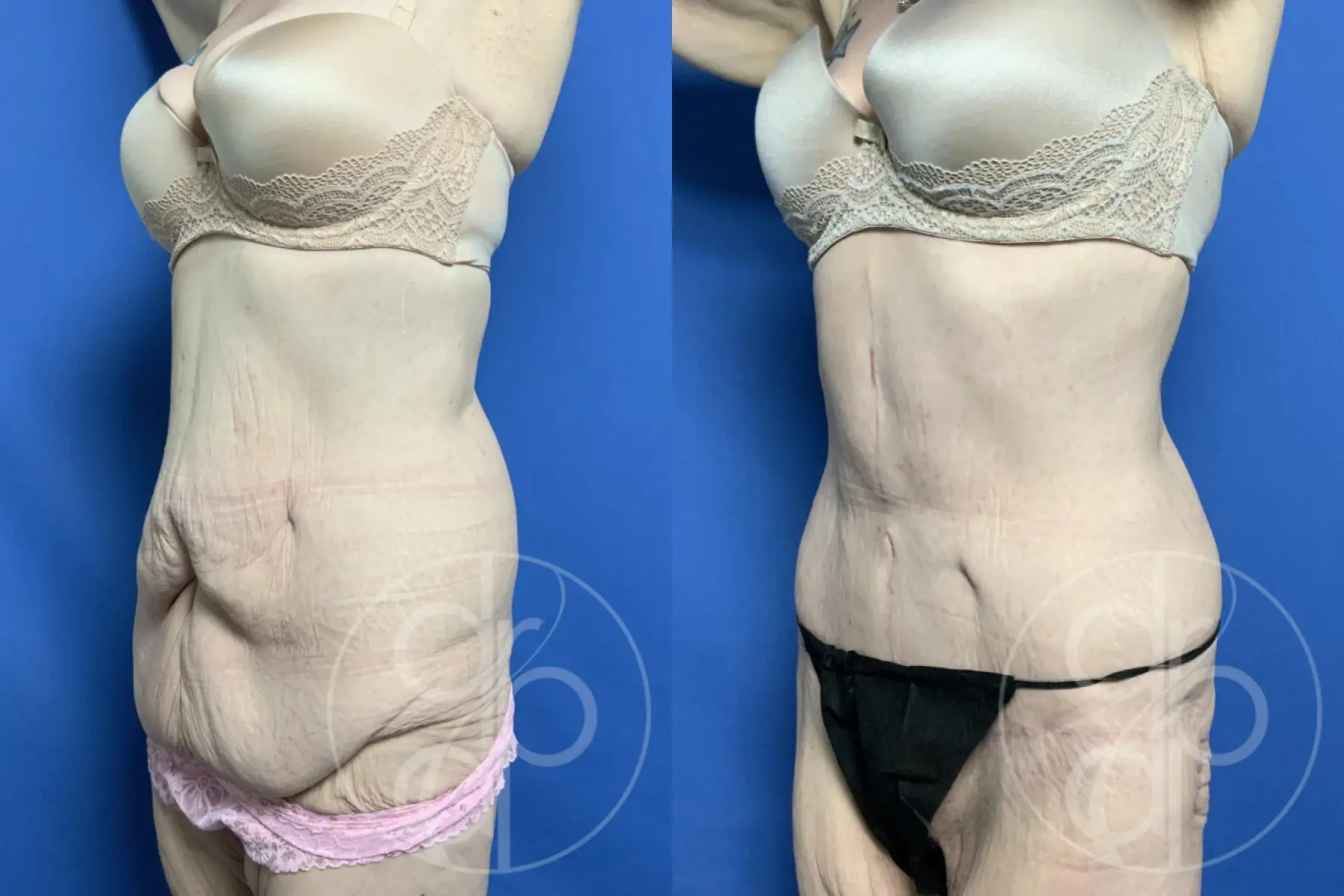 patient 12189 panniculectomy before and after result - Before and After 3