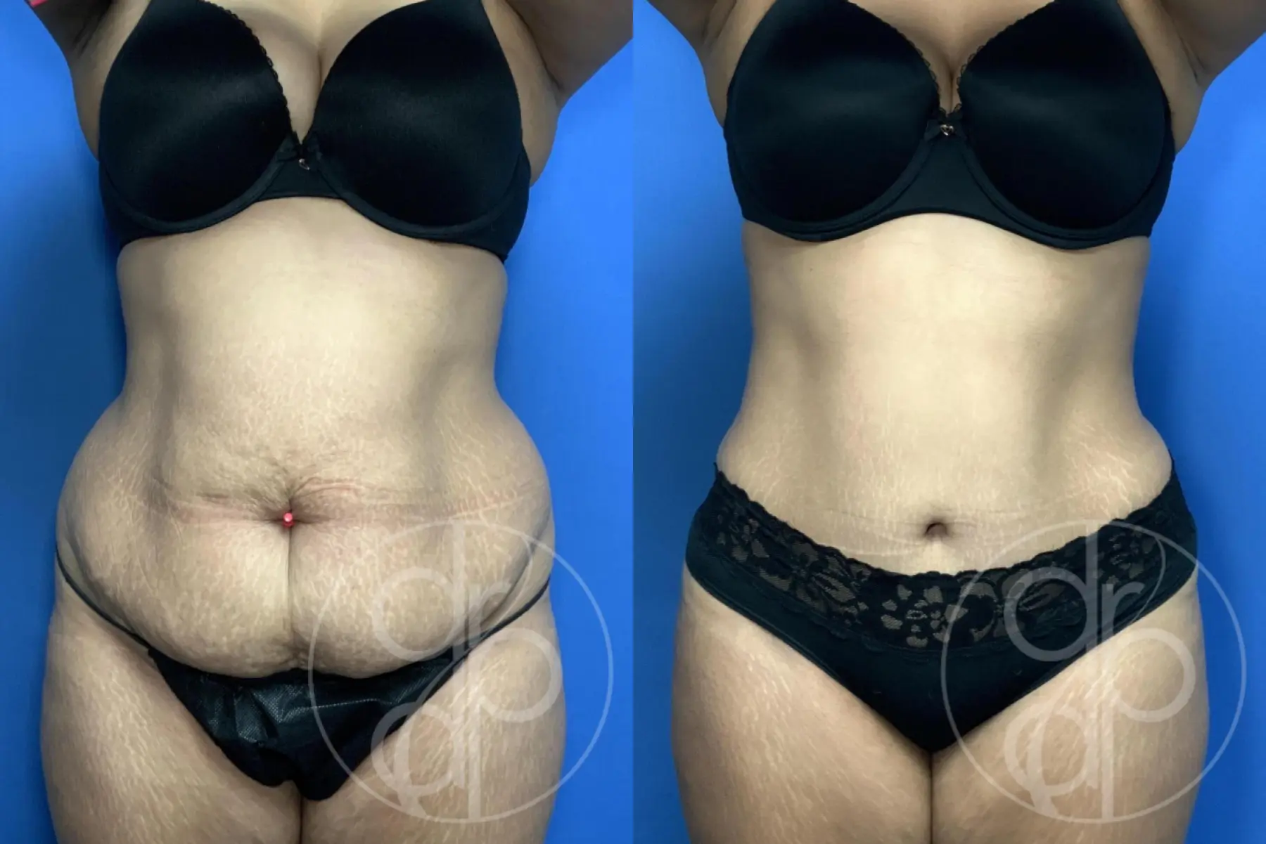 Abdominoplasty: Patient 38 - Before and After 2